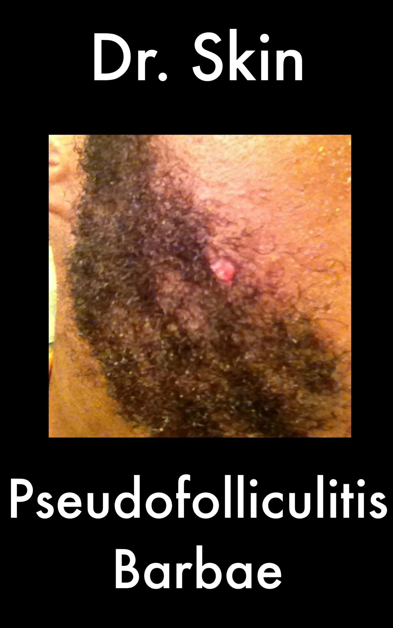 Pseudofolliculitis Barbae