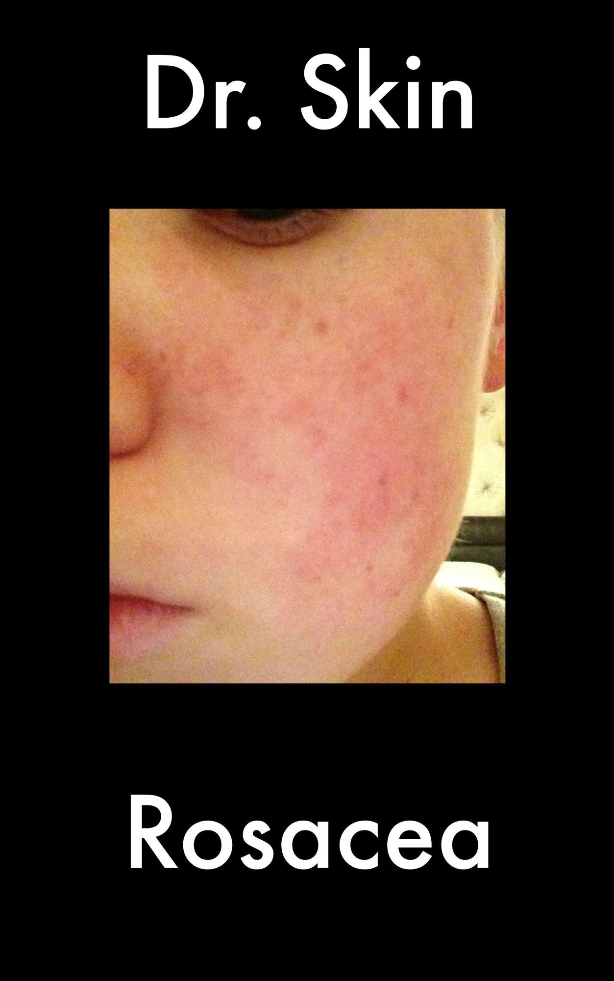 Rosacea