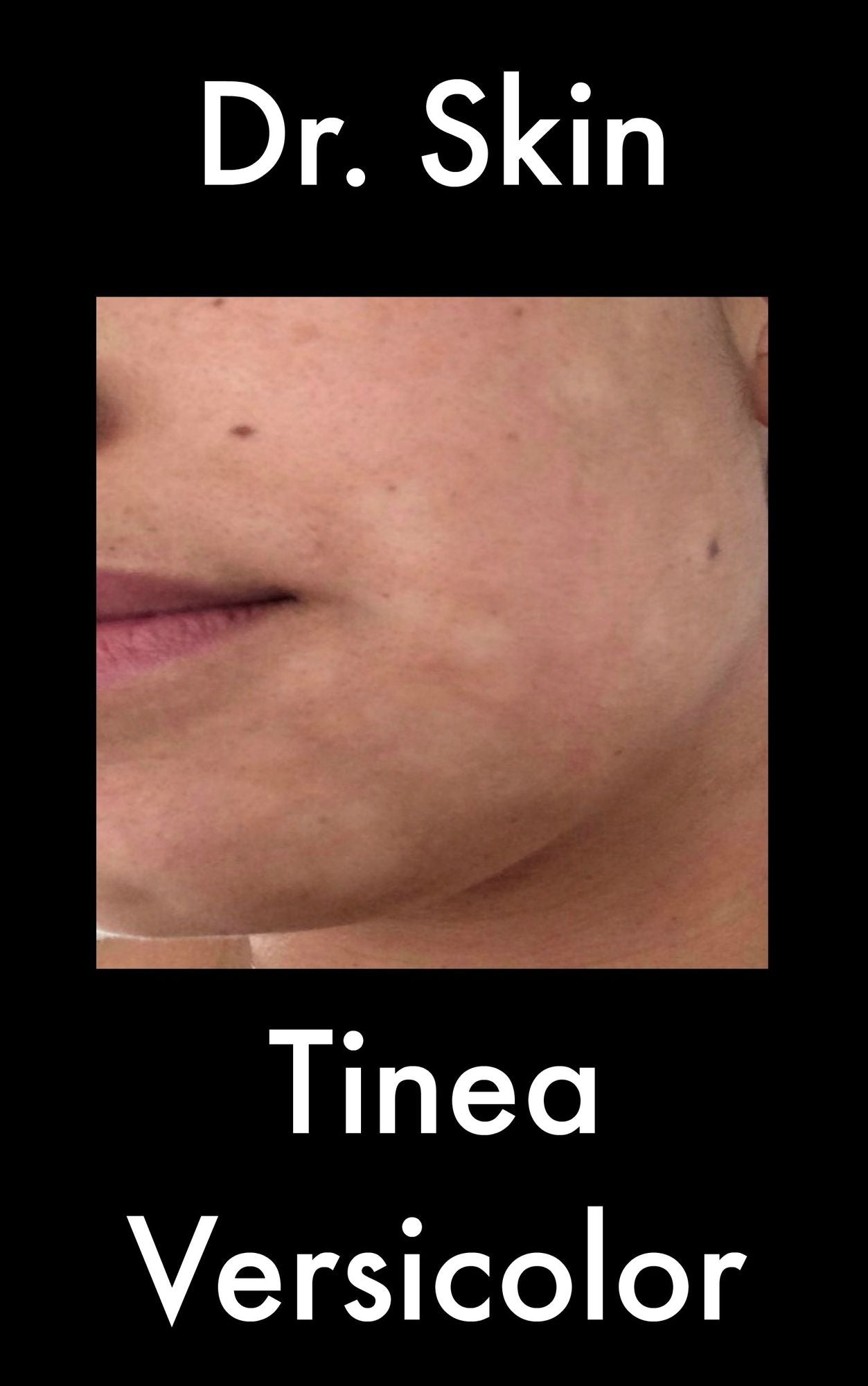 Tinea Versicolor