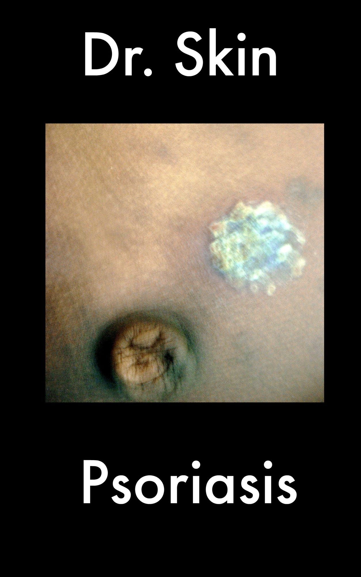 Psoriasis