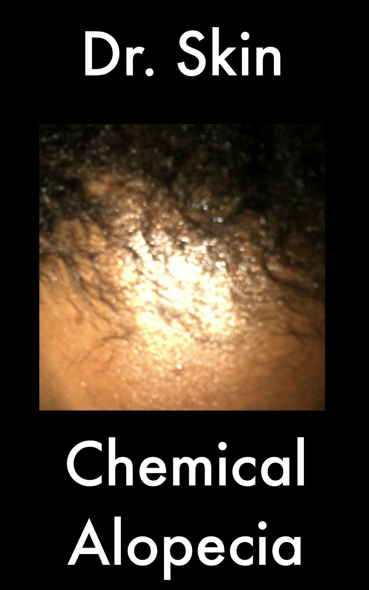 Chemical Alopecia