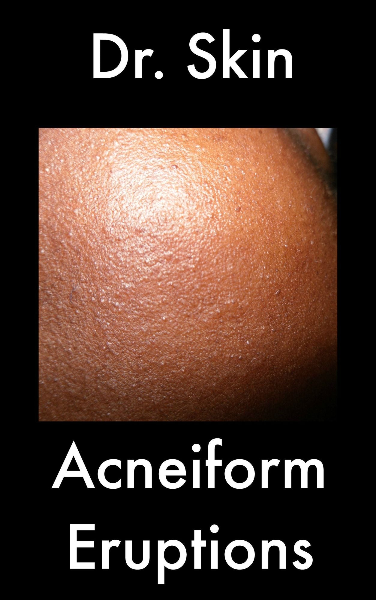 Acneiform Eruptions