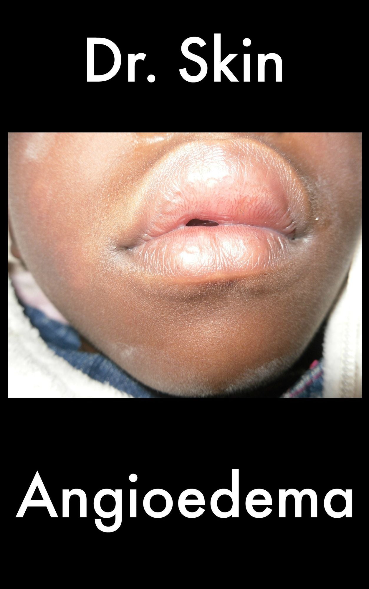 Angioedema