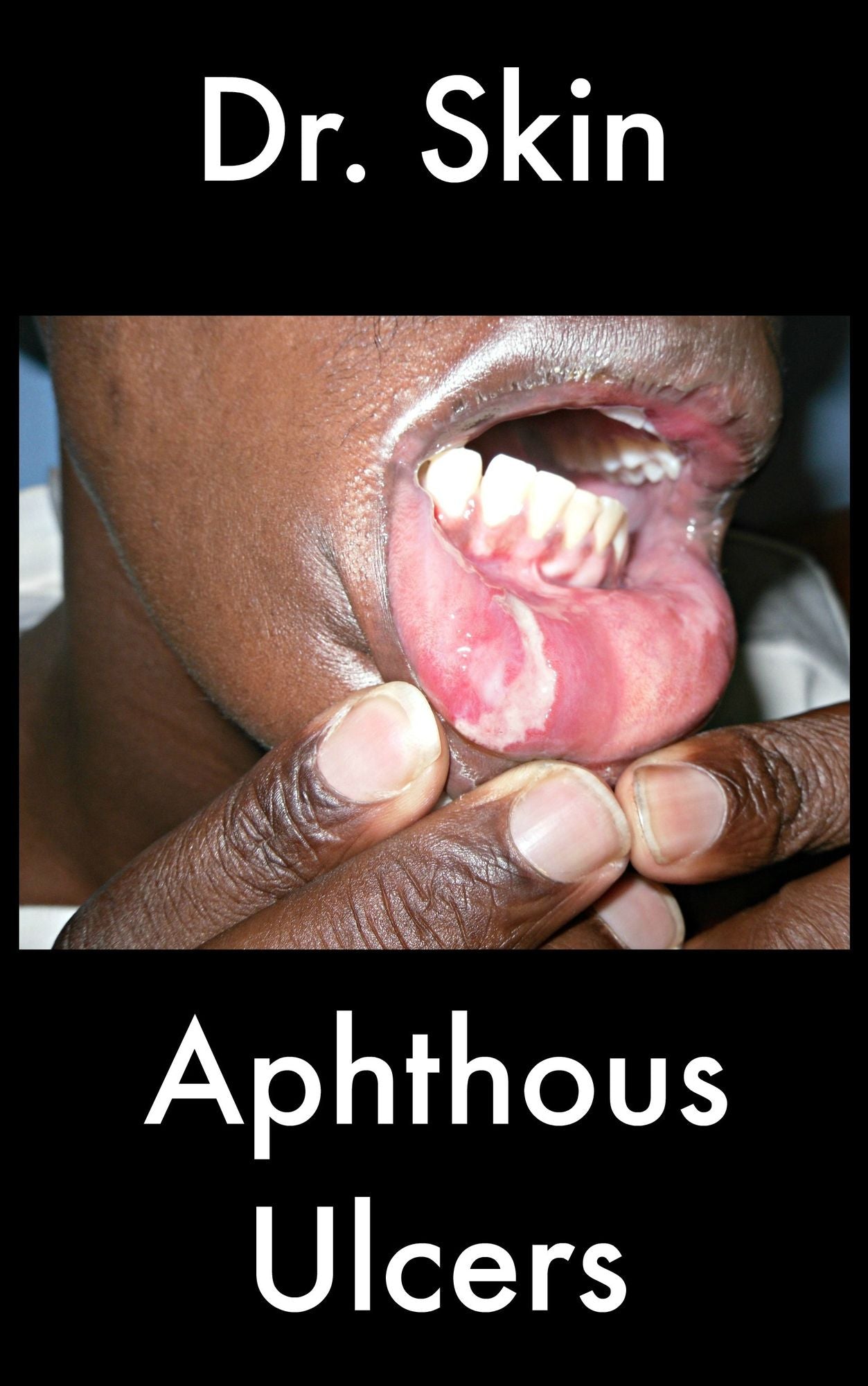Aphthous Ulcers