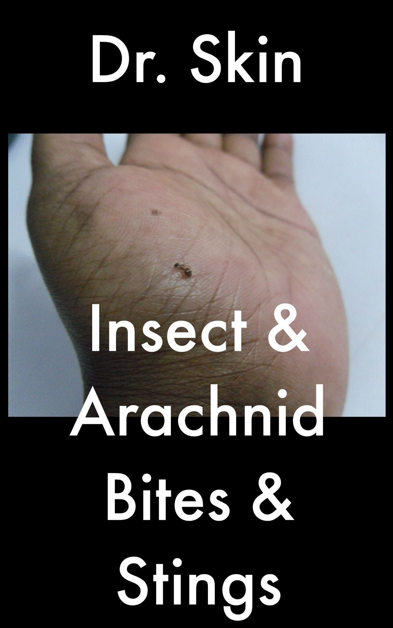Insect and Arachnid Bites and Stings