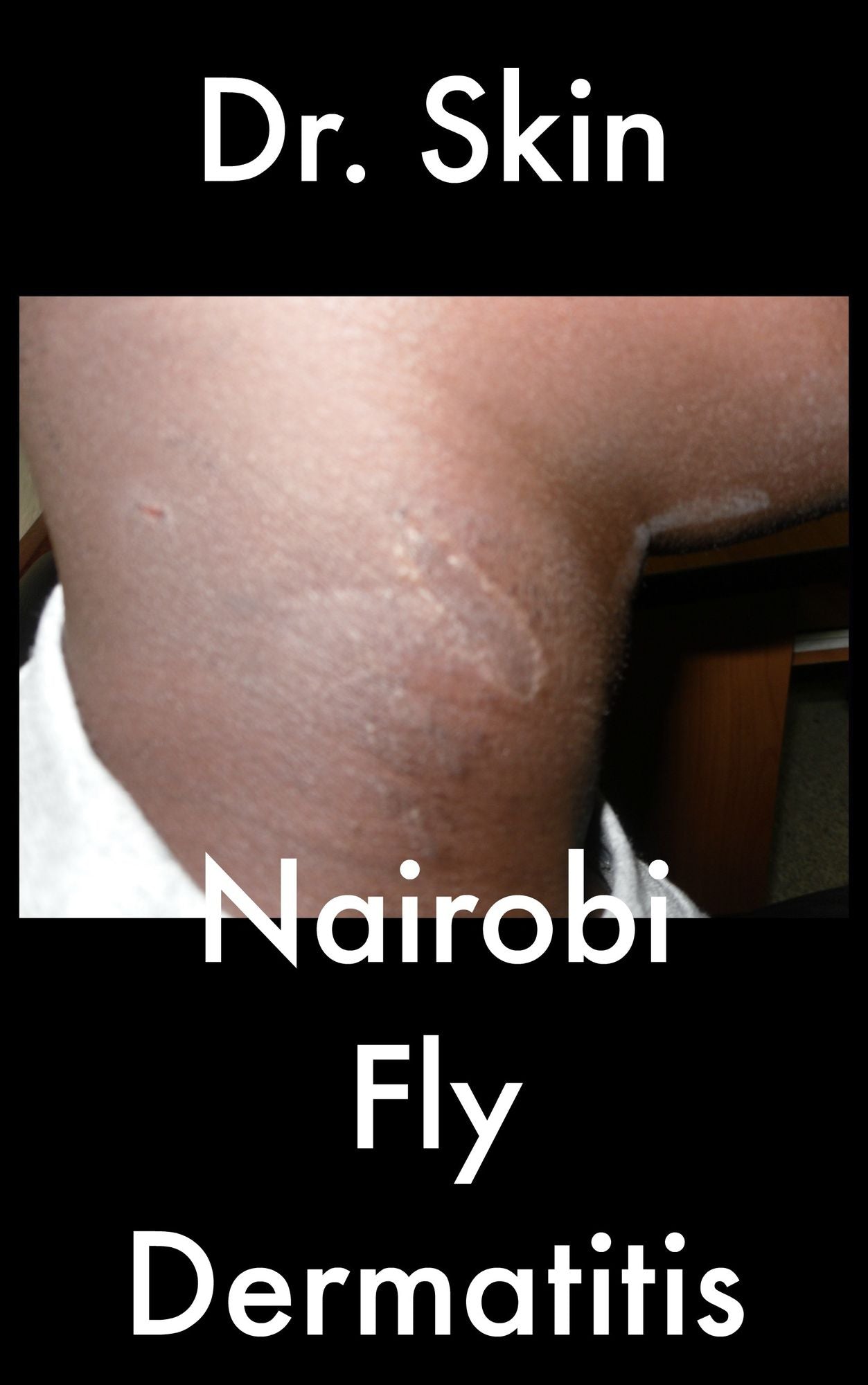 Nairobi Fly Dermatitis