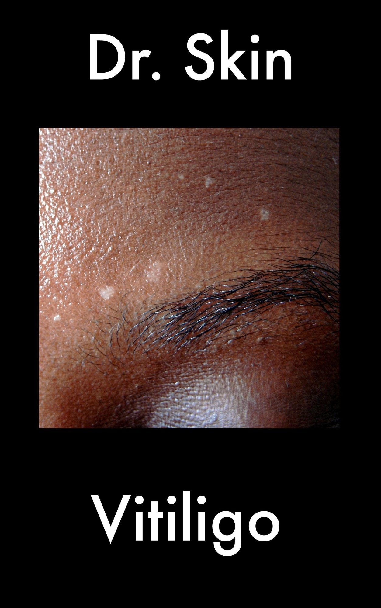 Vitiligo