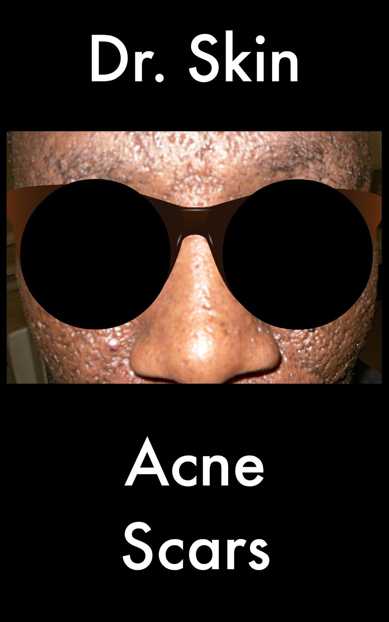 Acne Scars