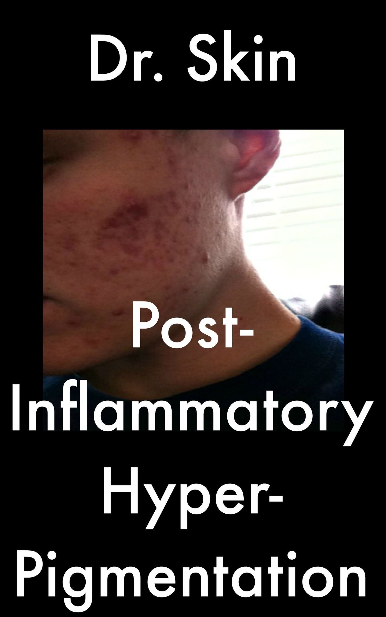 Post Inflammatory Hyperpigmentation