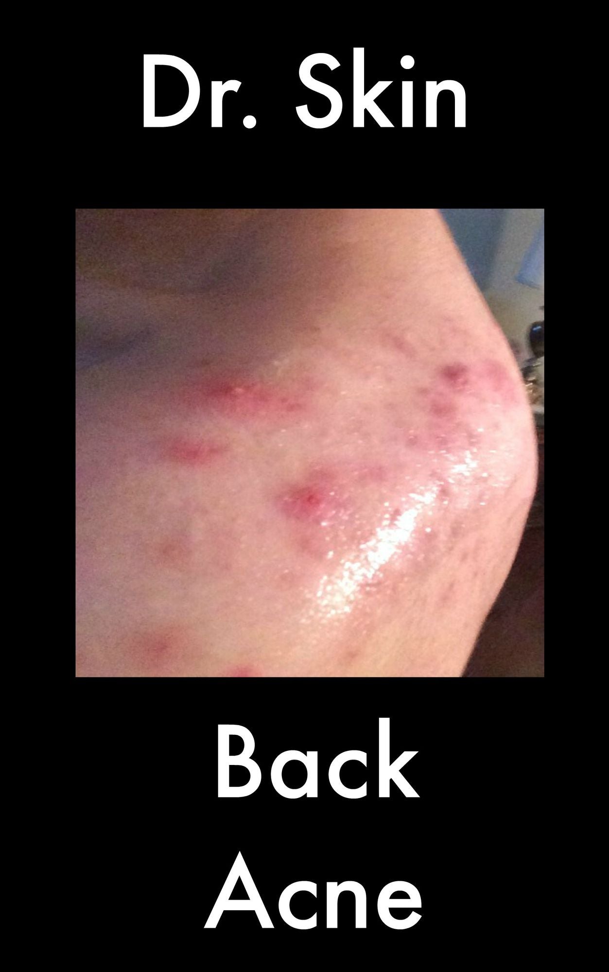 Back Acne
