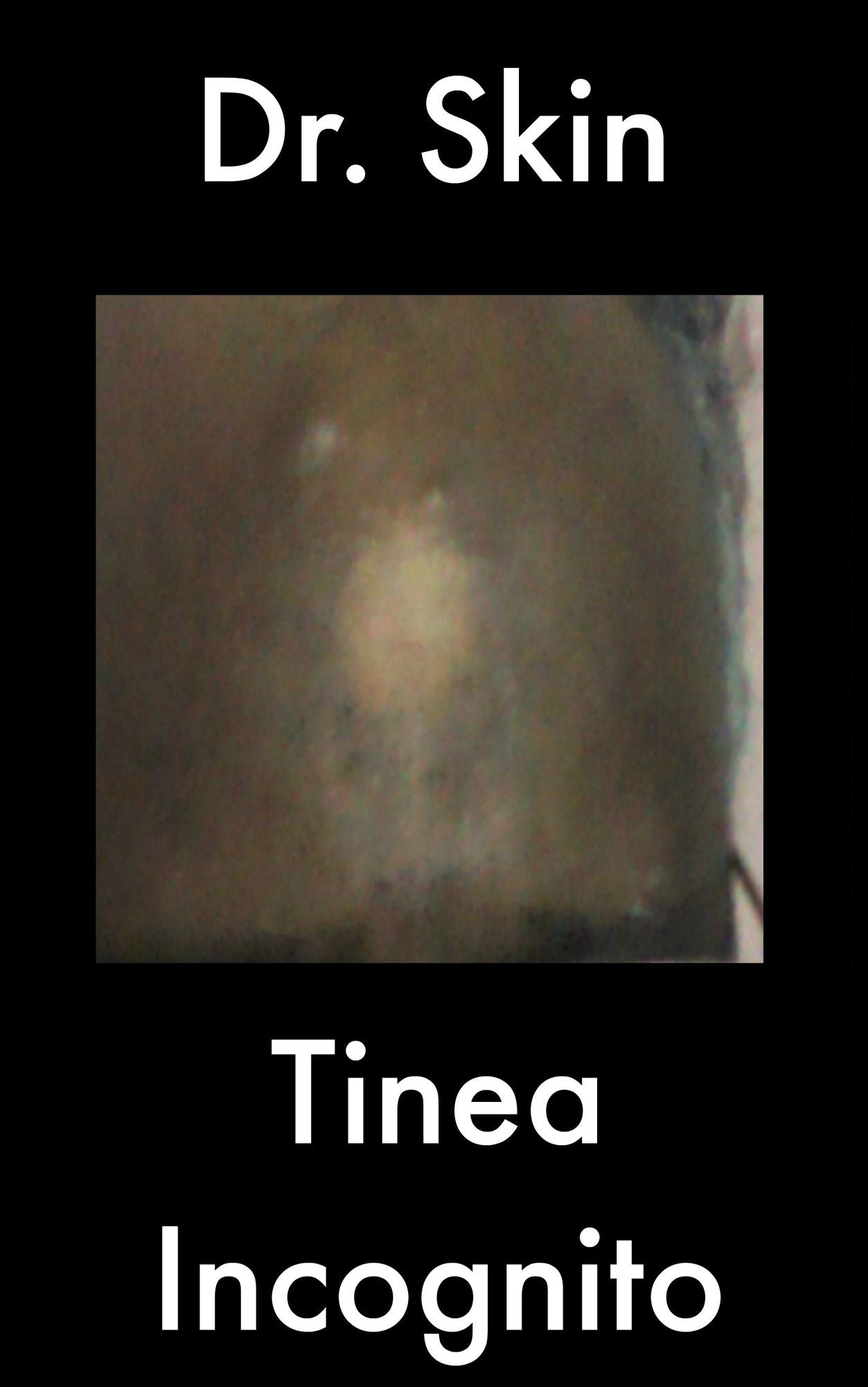 Tinea Incognito