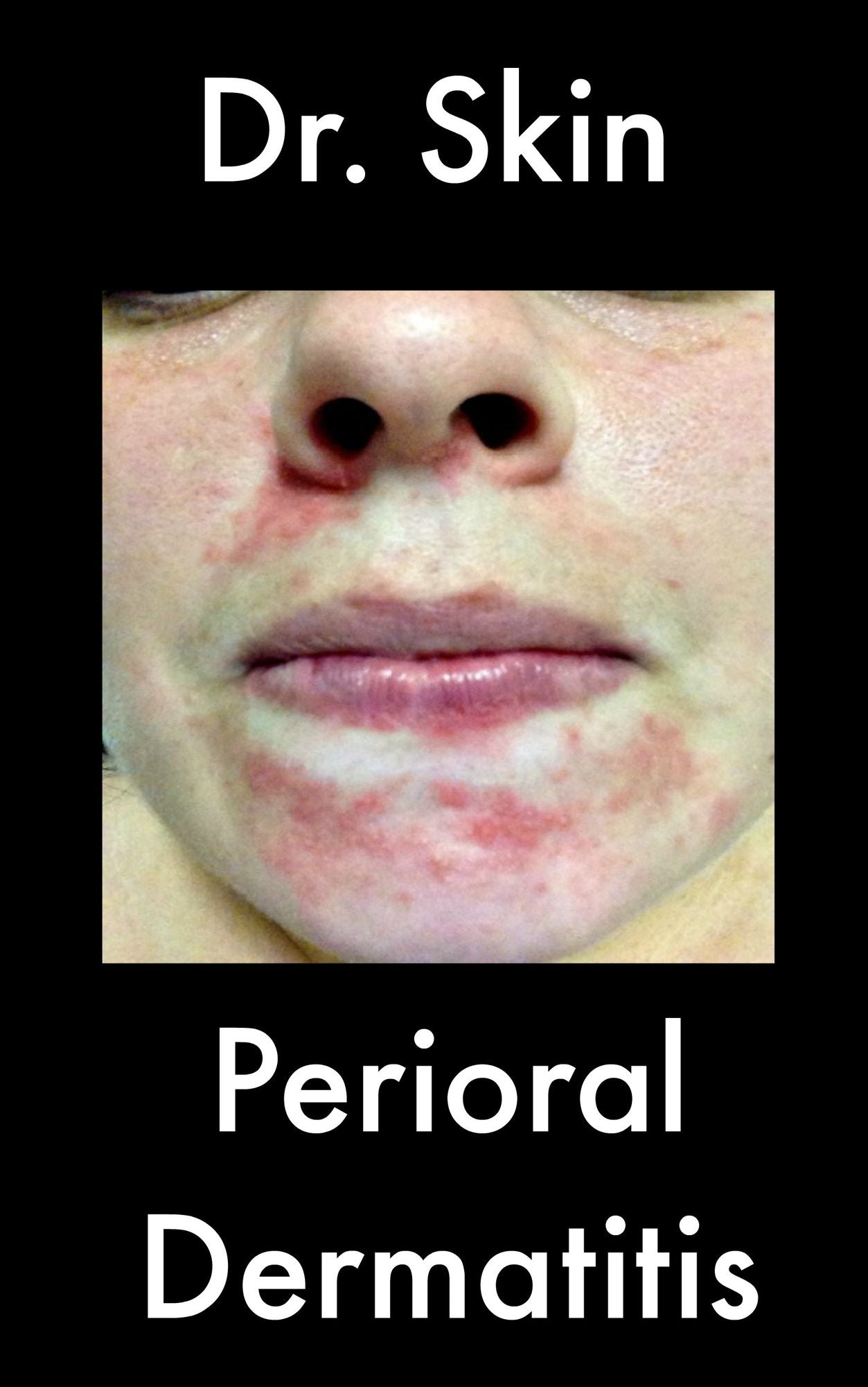Perioral Dermatitis