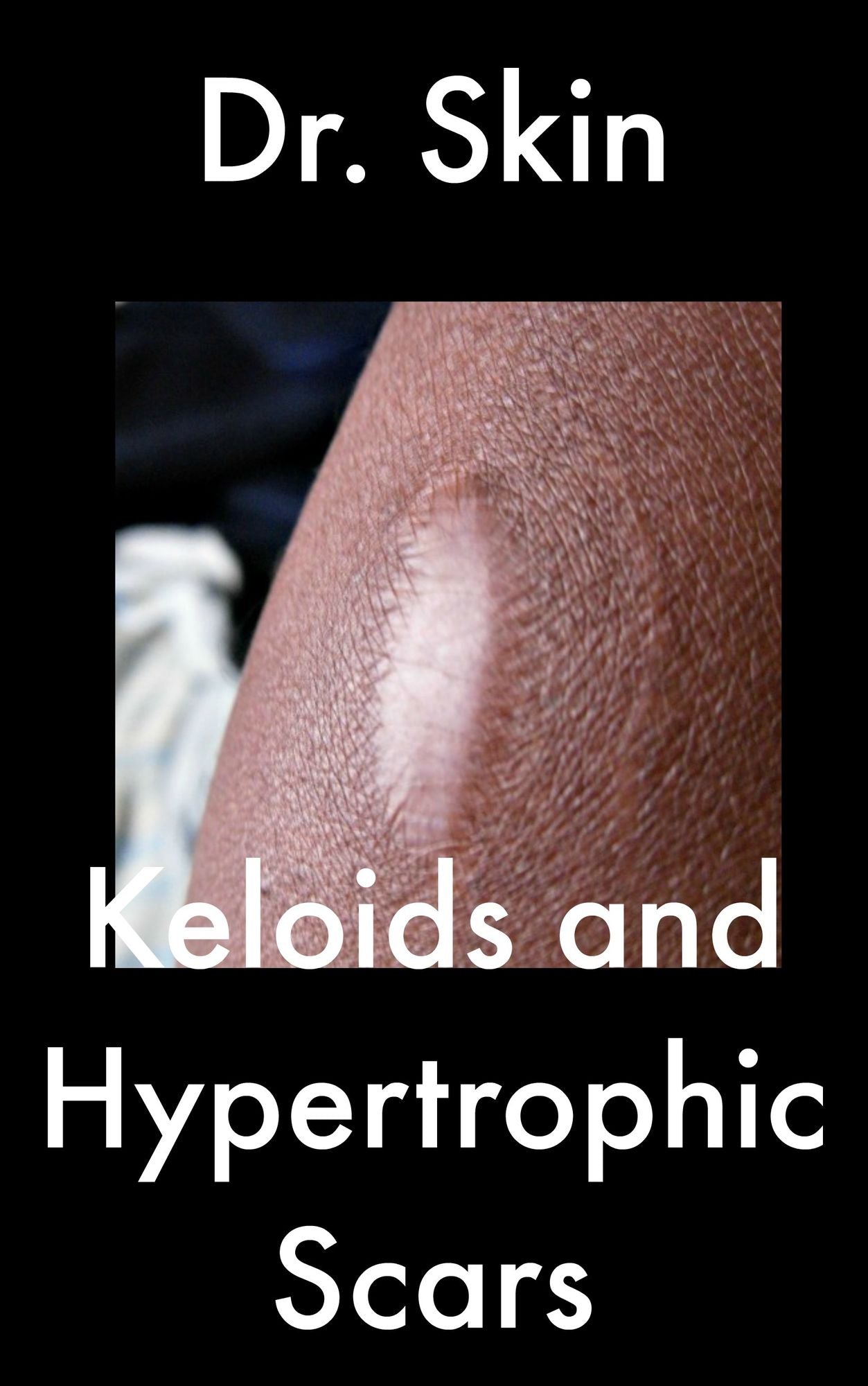 Keloids and Hypertrophic Scars