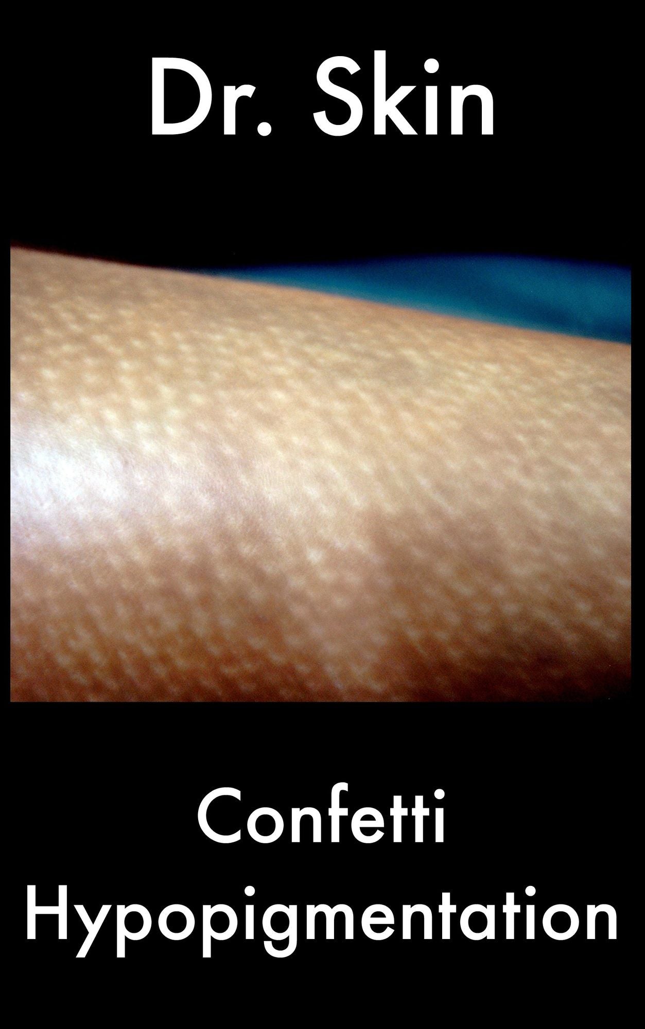 Confetti Hypopigmentation