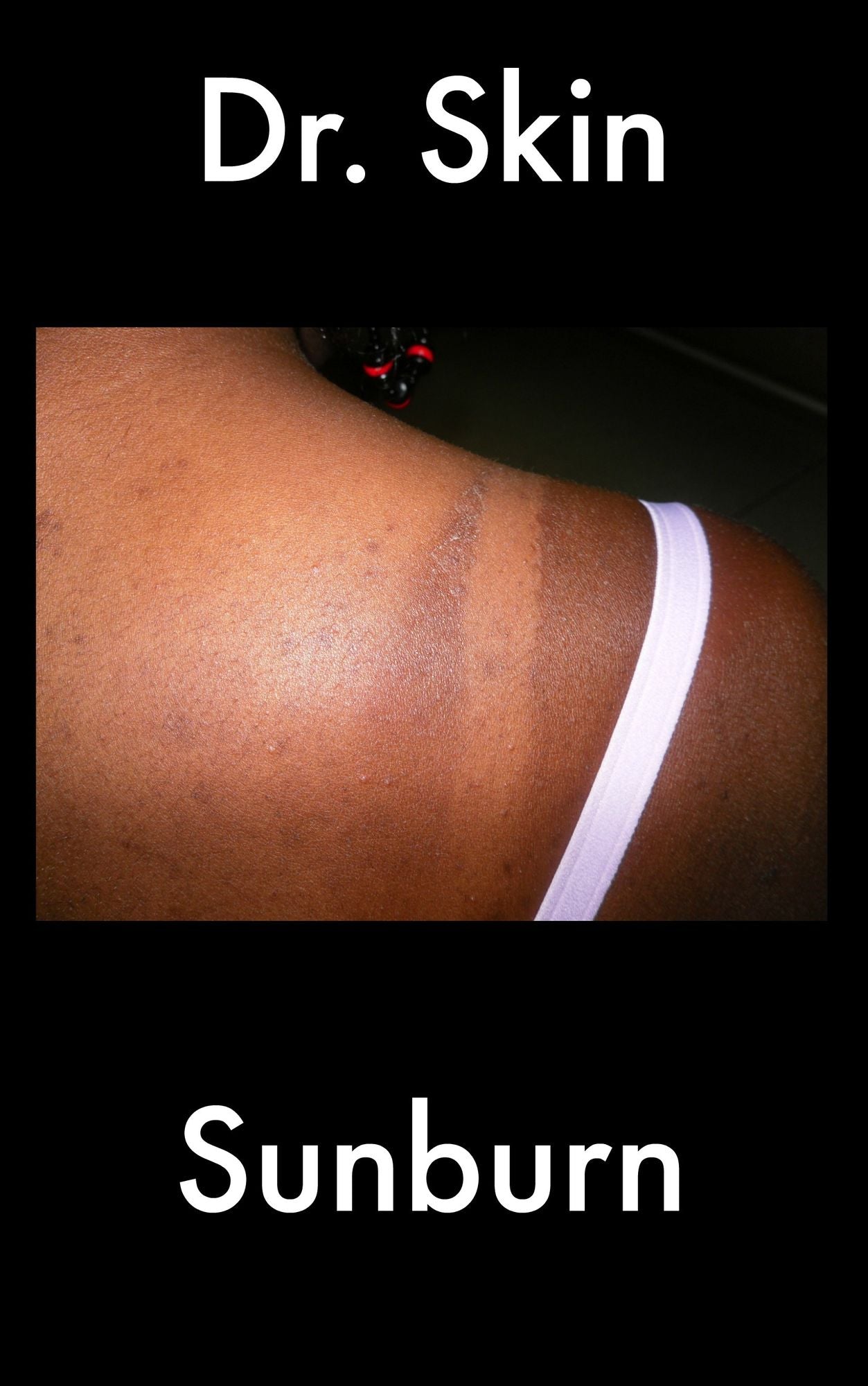Sunburn