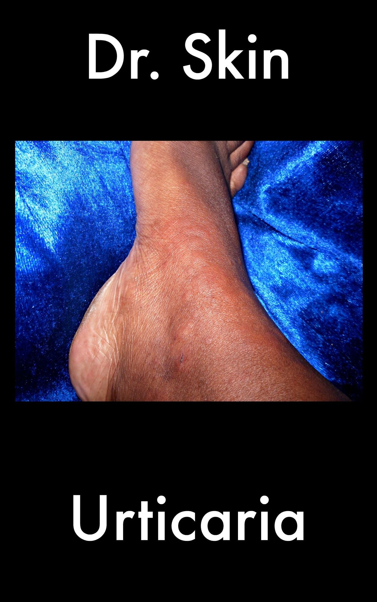 Urticaria