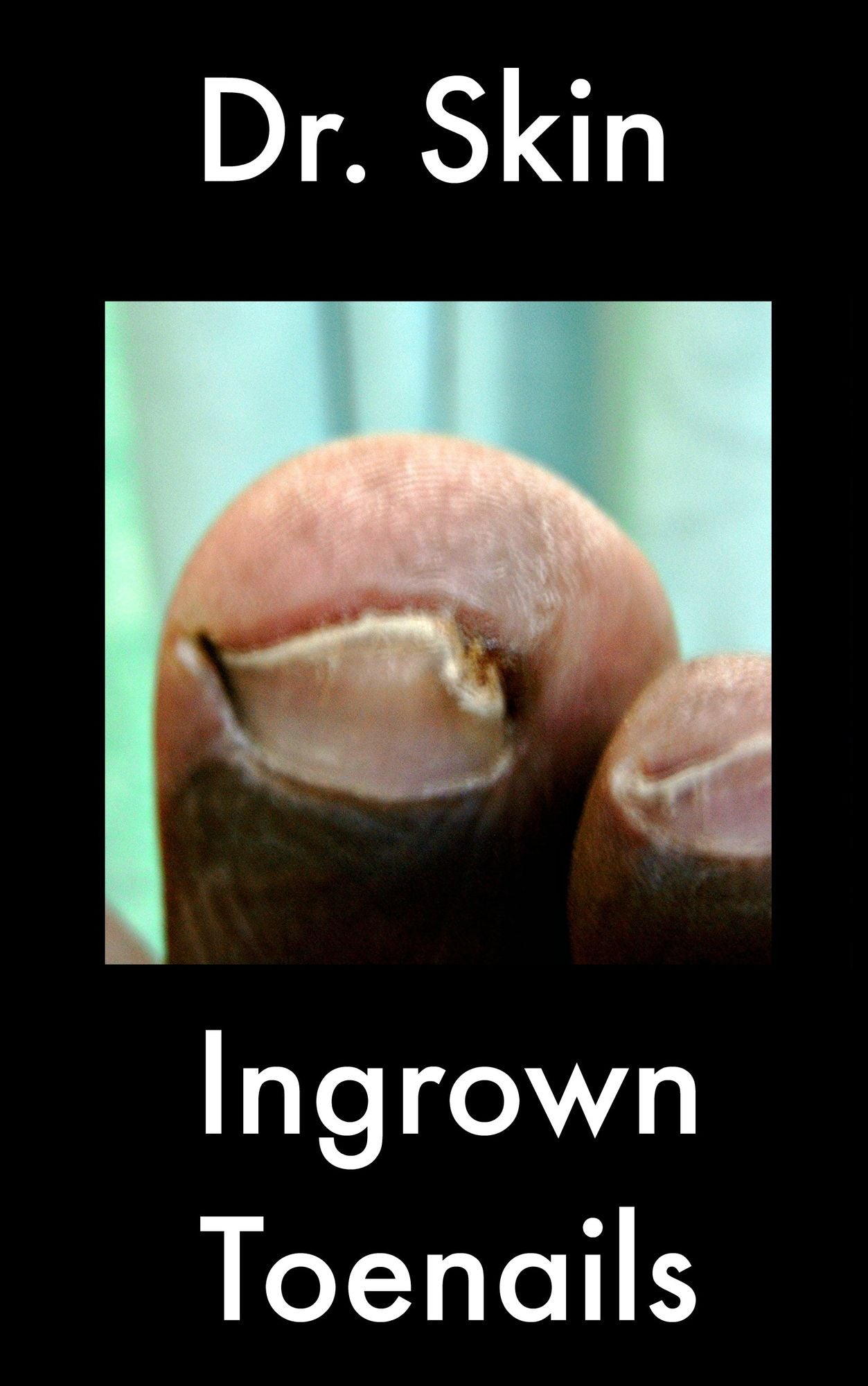 Ingrown Toenails