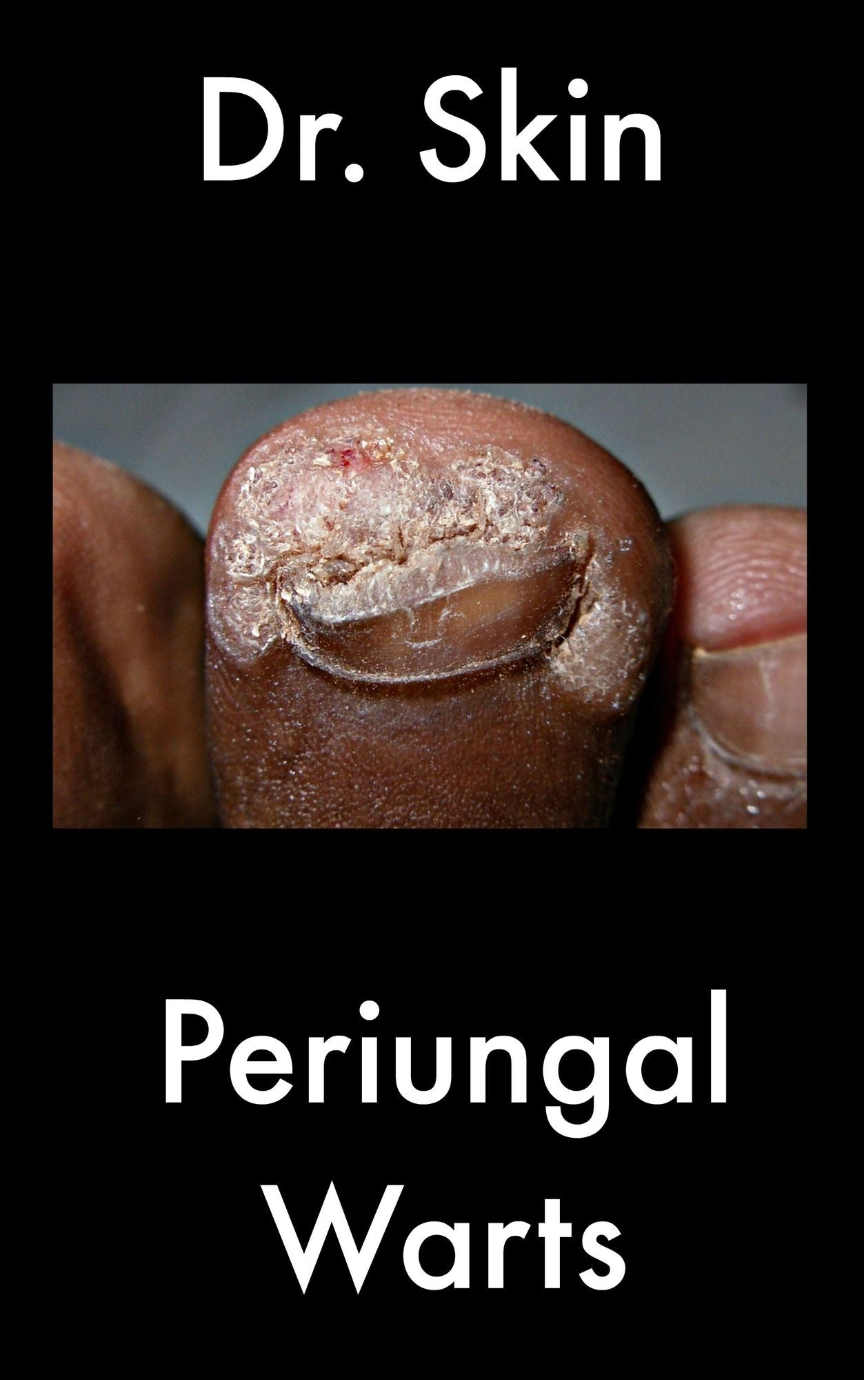 Periungal Warts