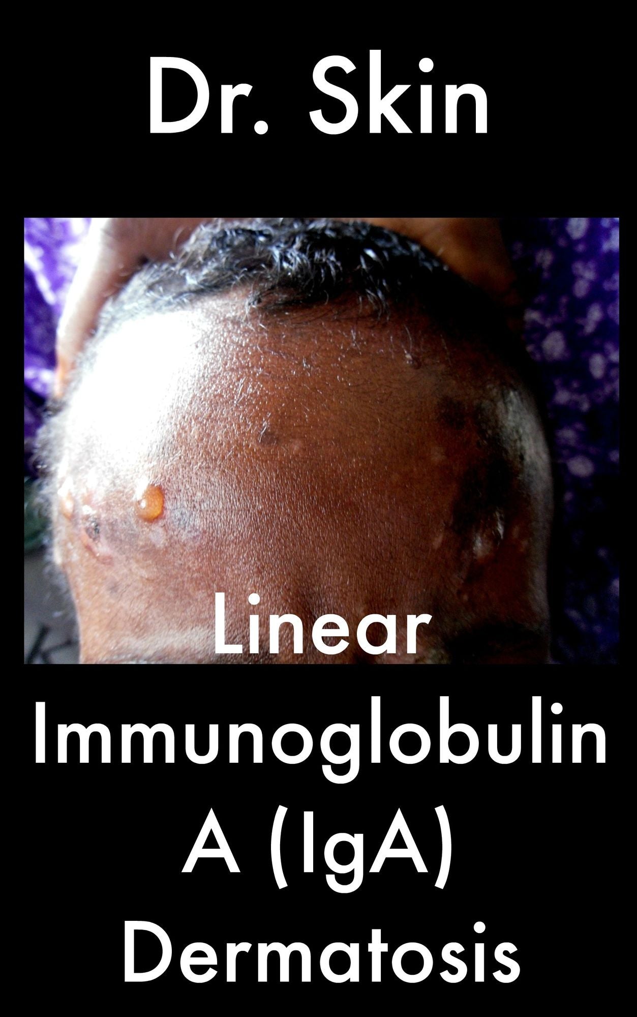Linear Immunoglobulin A Dermatosis