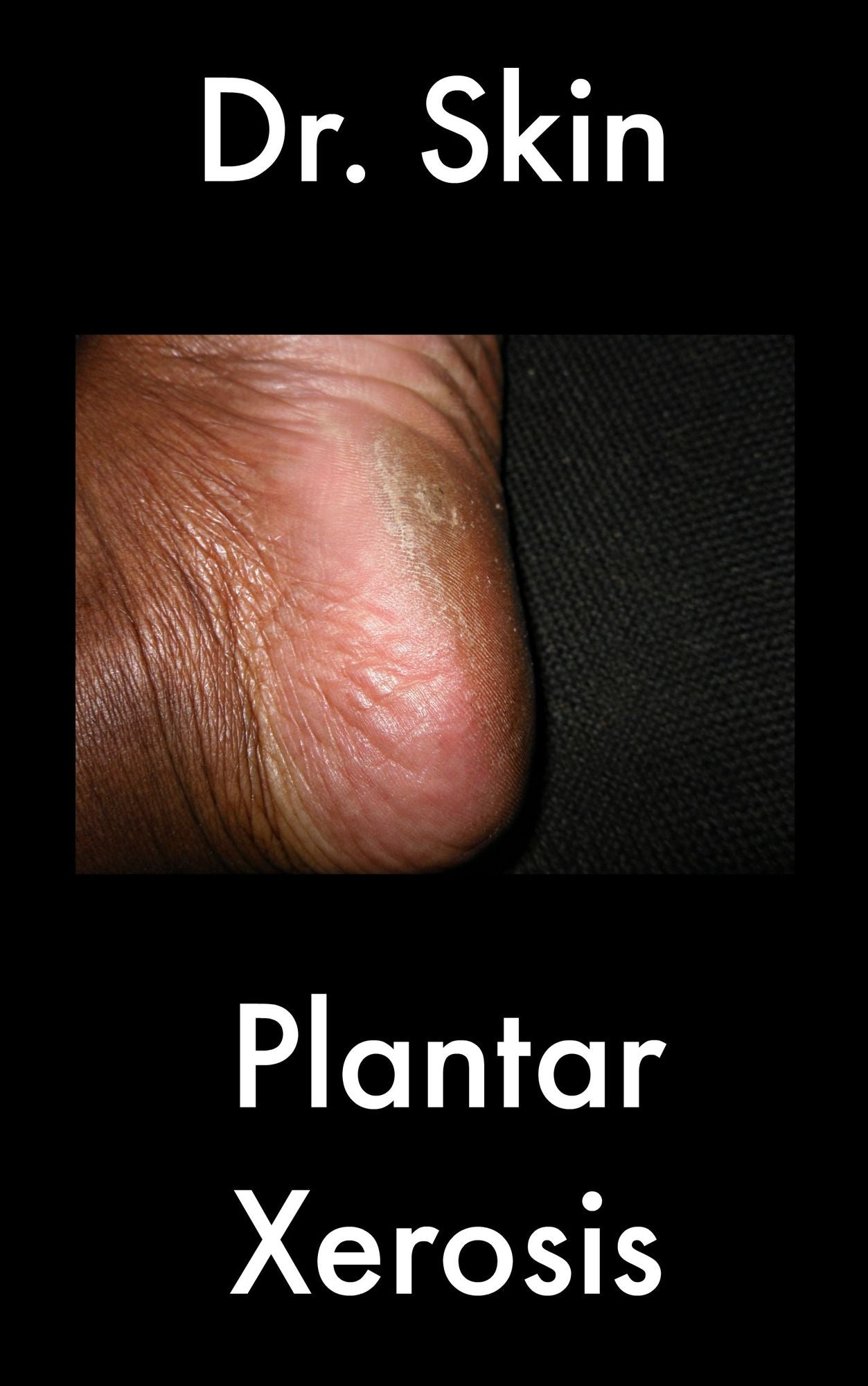 Plantar Xerosis