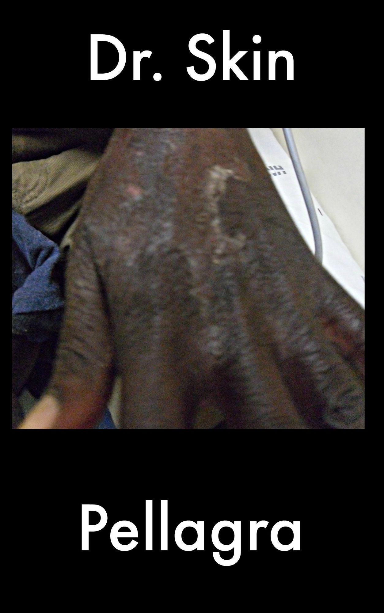 Pellagra