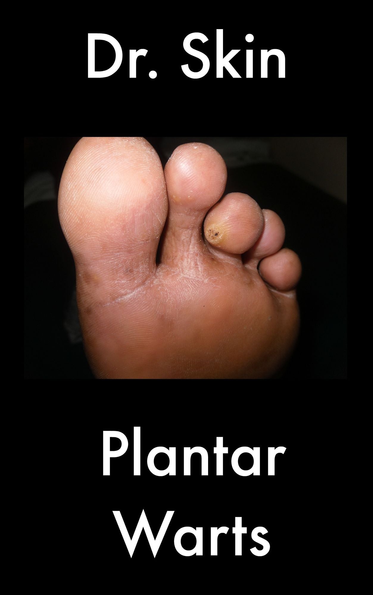 Plantar Warts