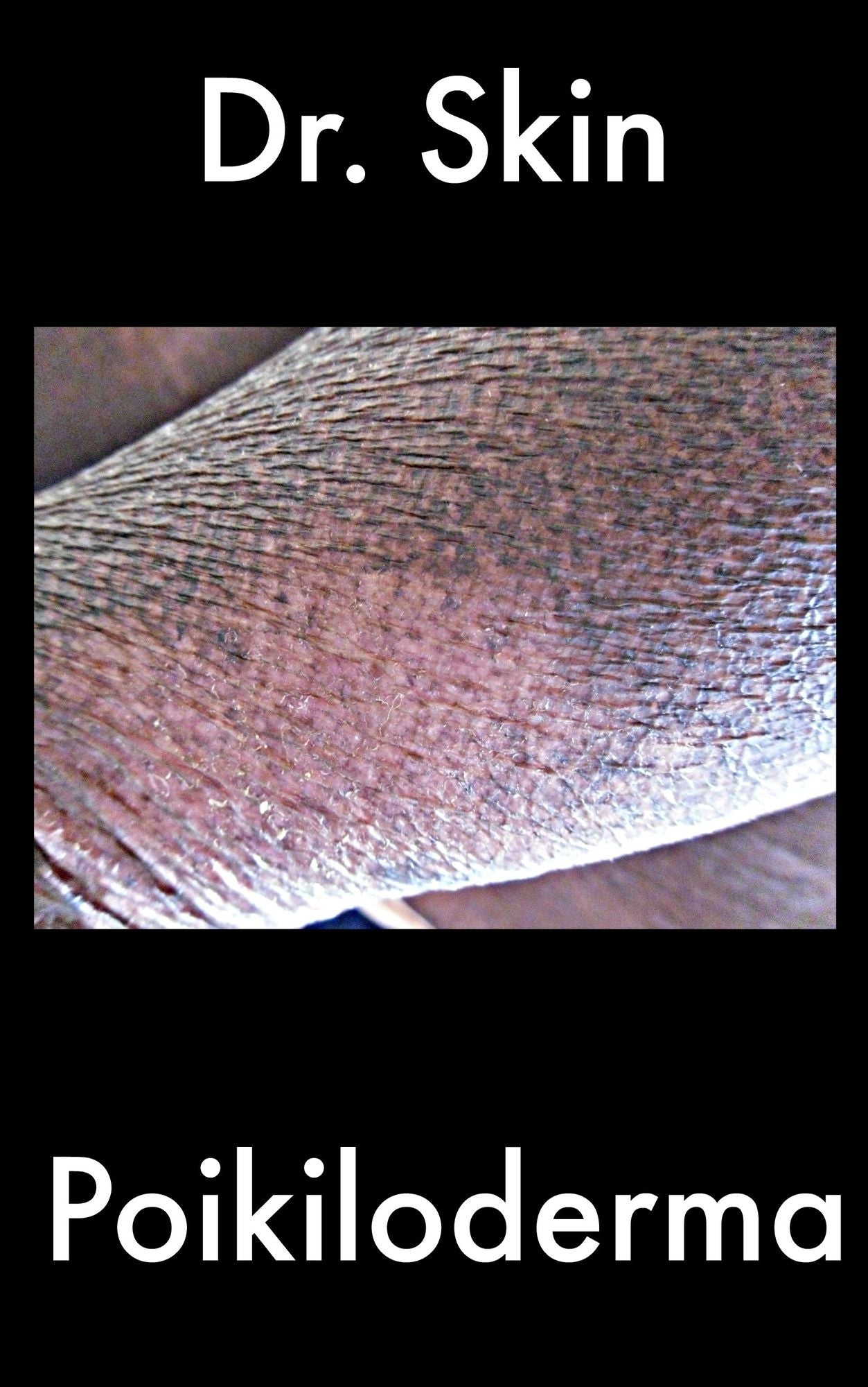 Poikiloderma
