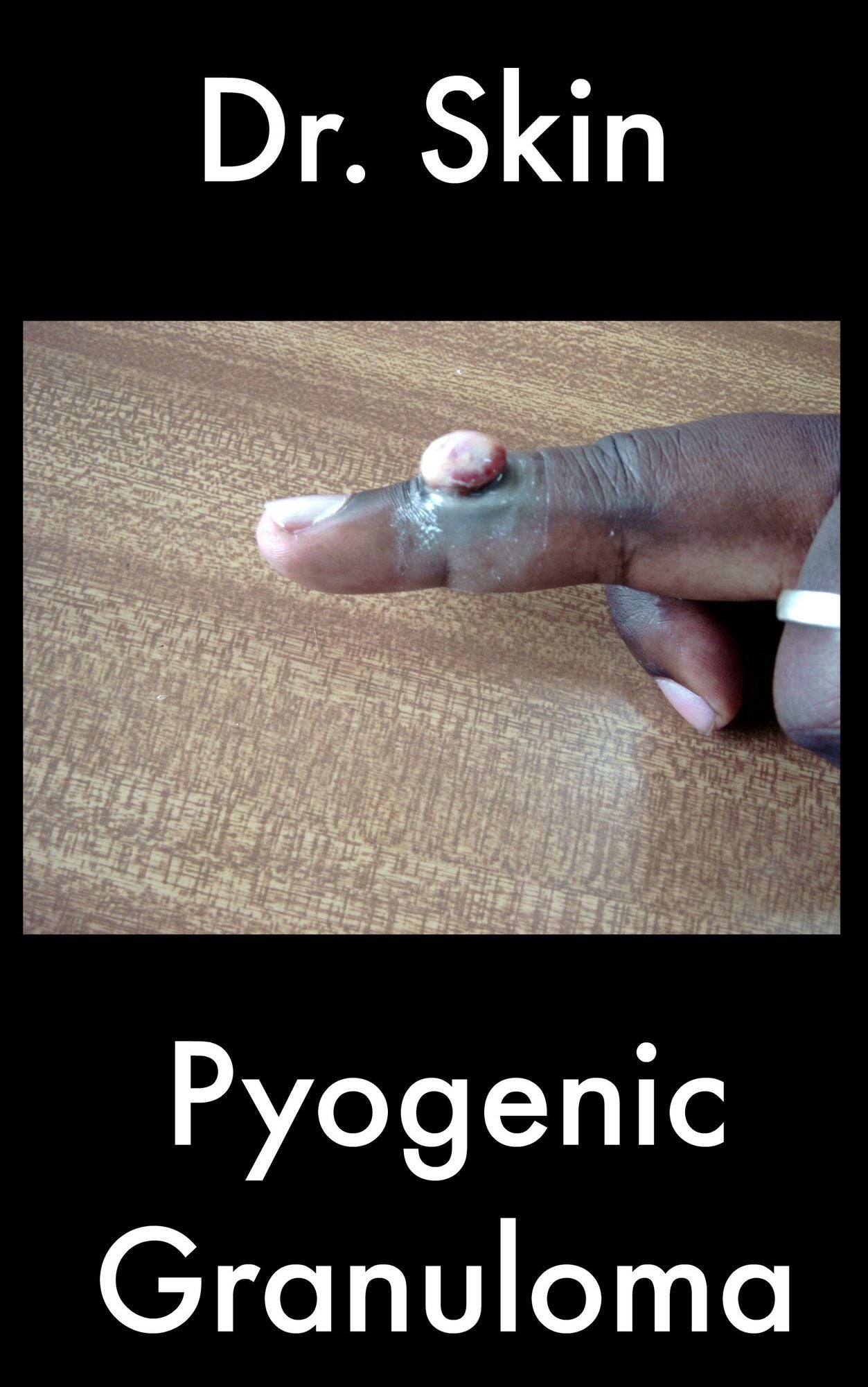 Pyogenic Granuloma