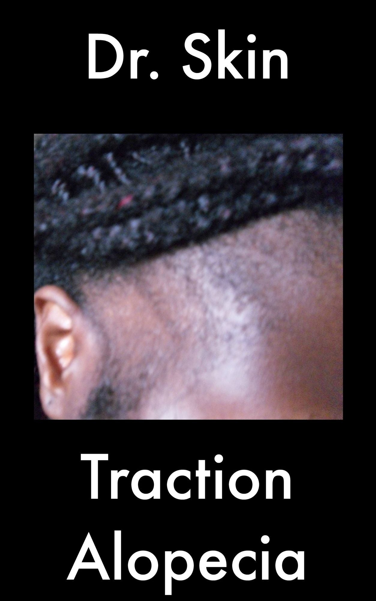 Traction Alopecia