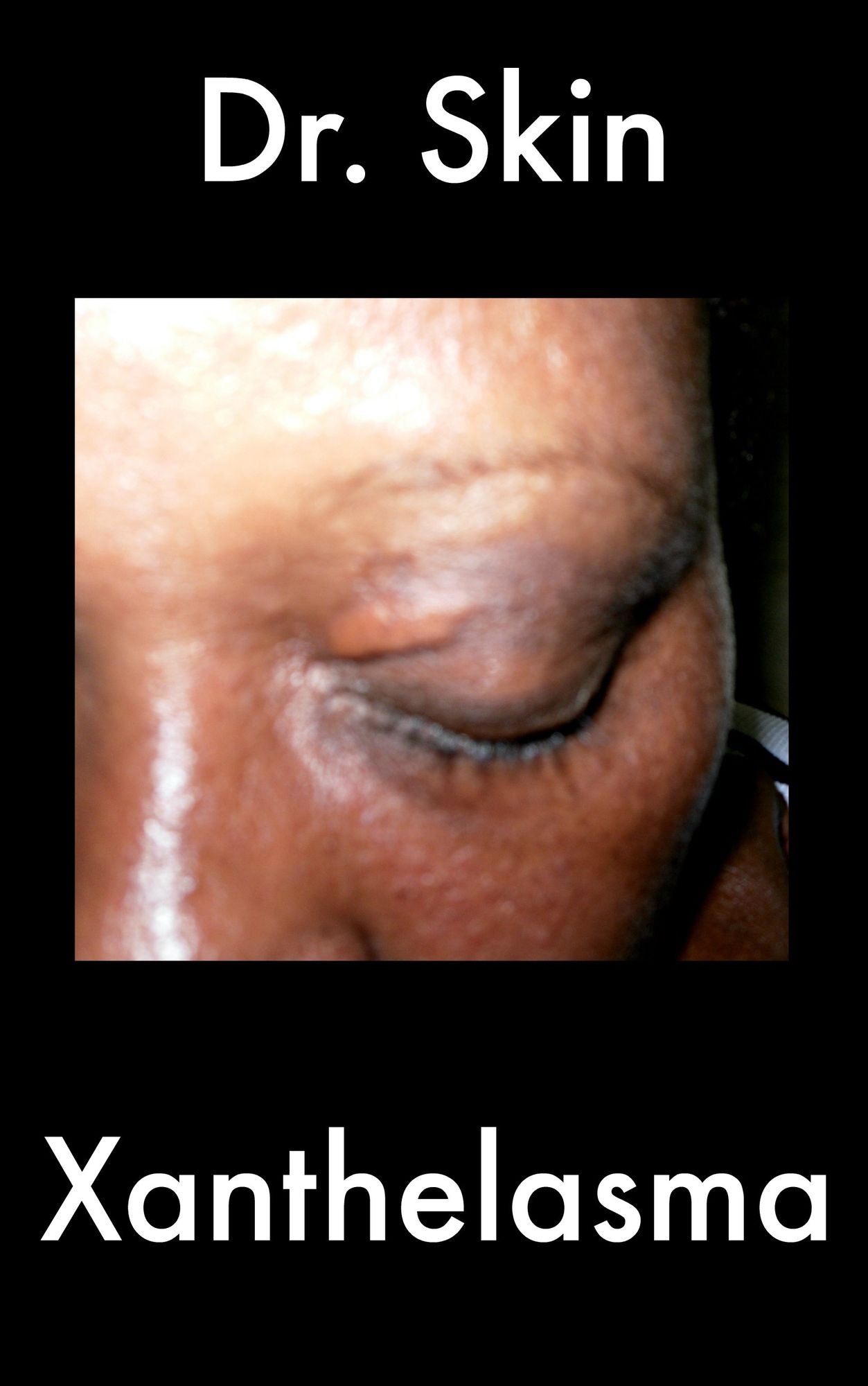 Xanthelasma