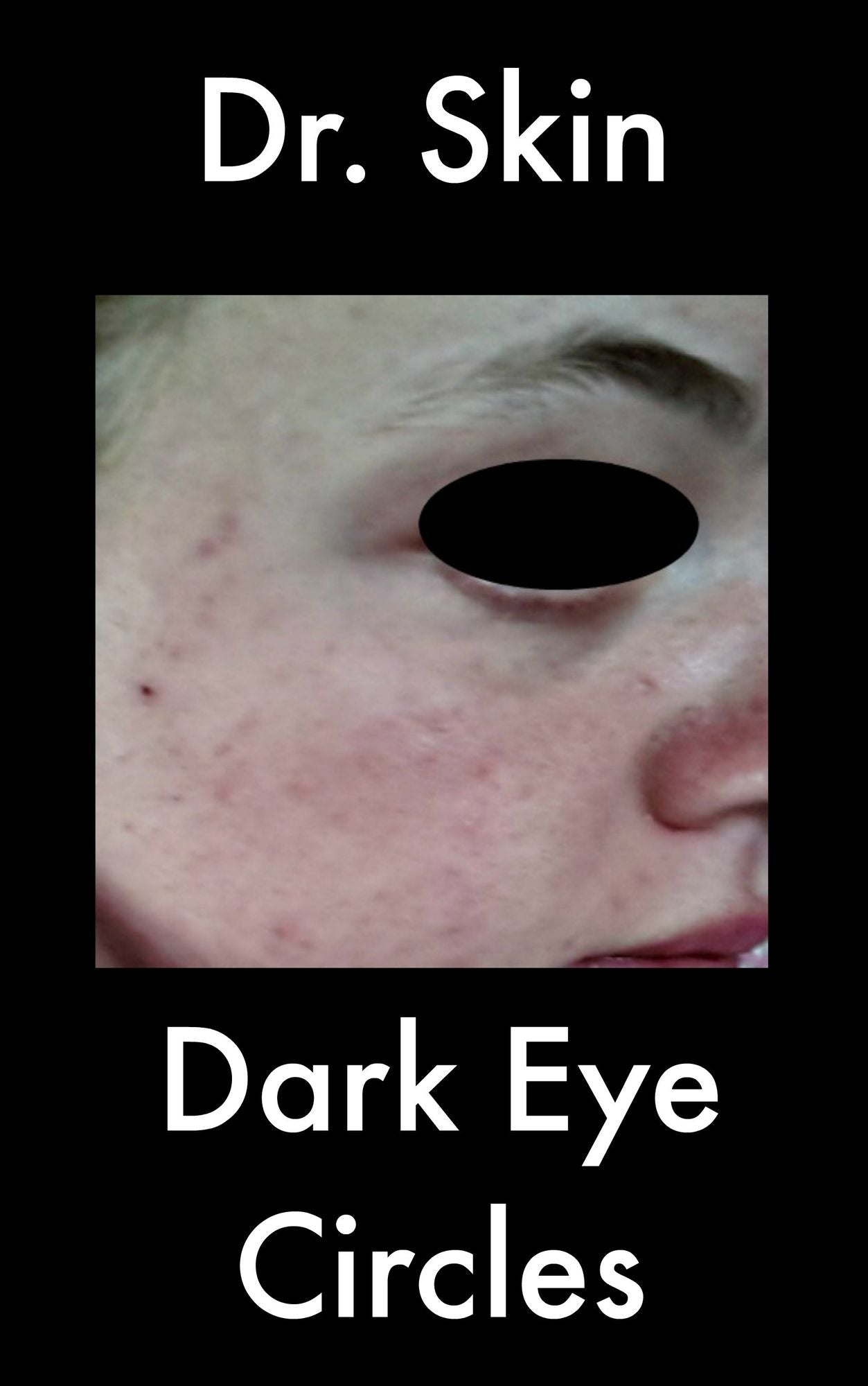 Dark Eye Circles