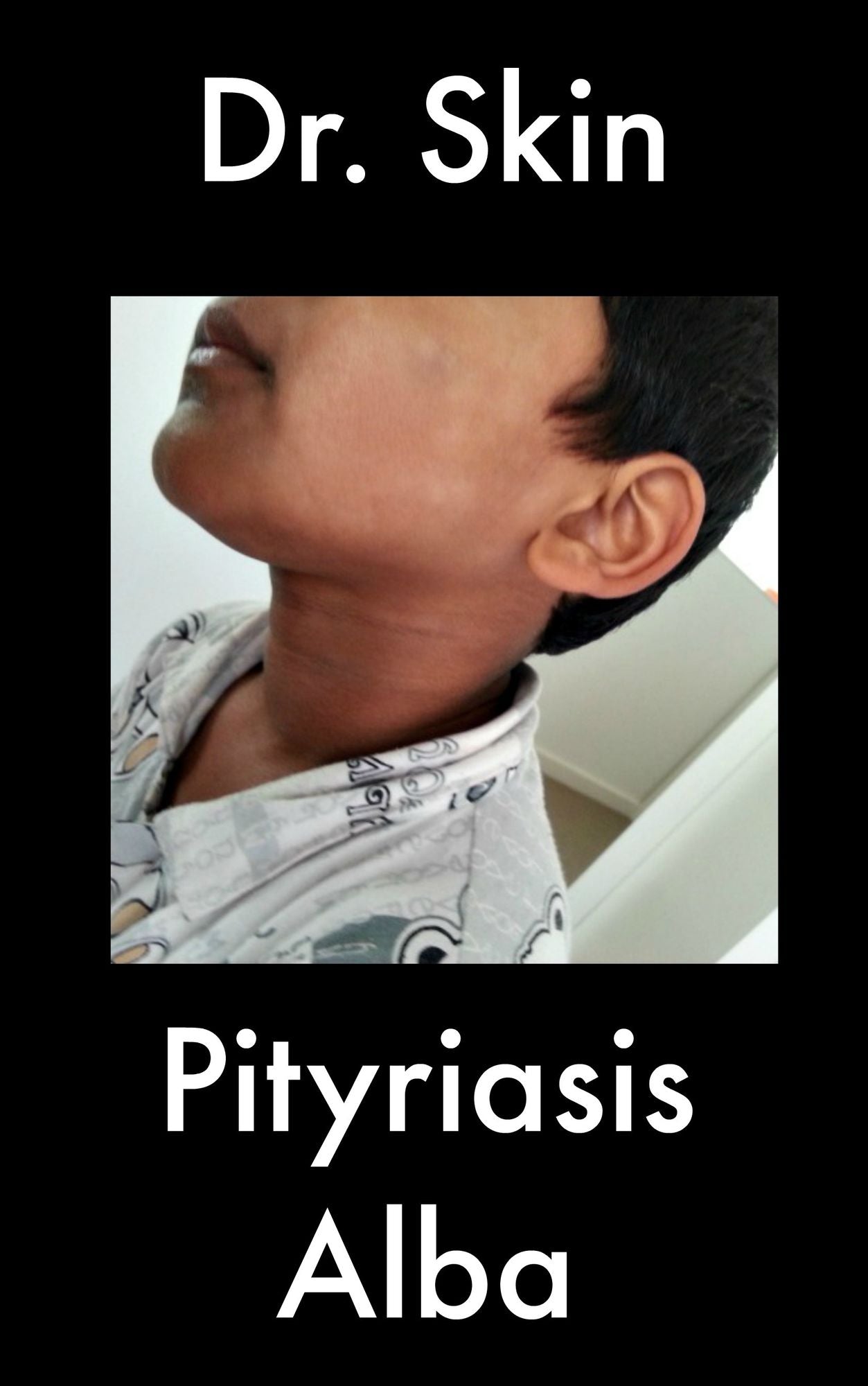 Pityriasis Alba