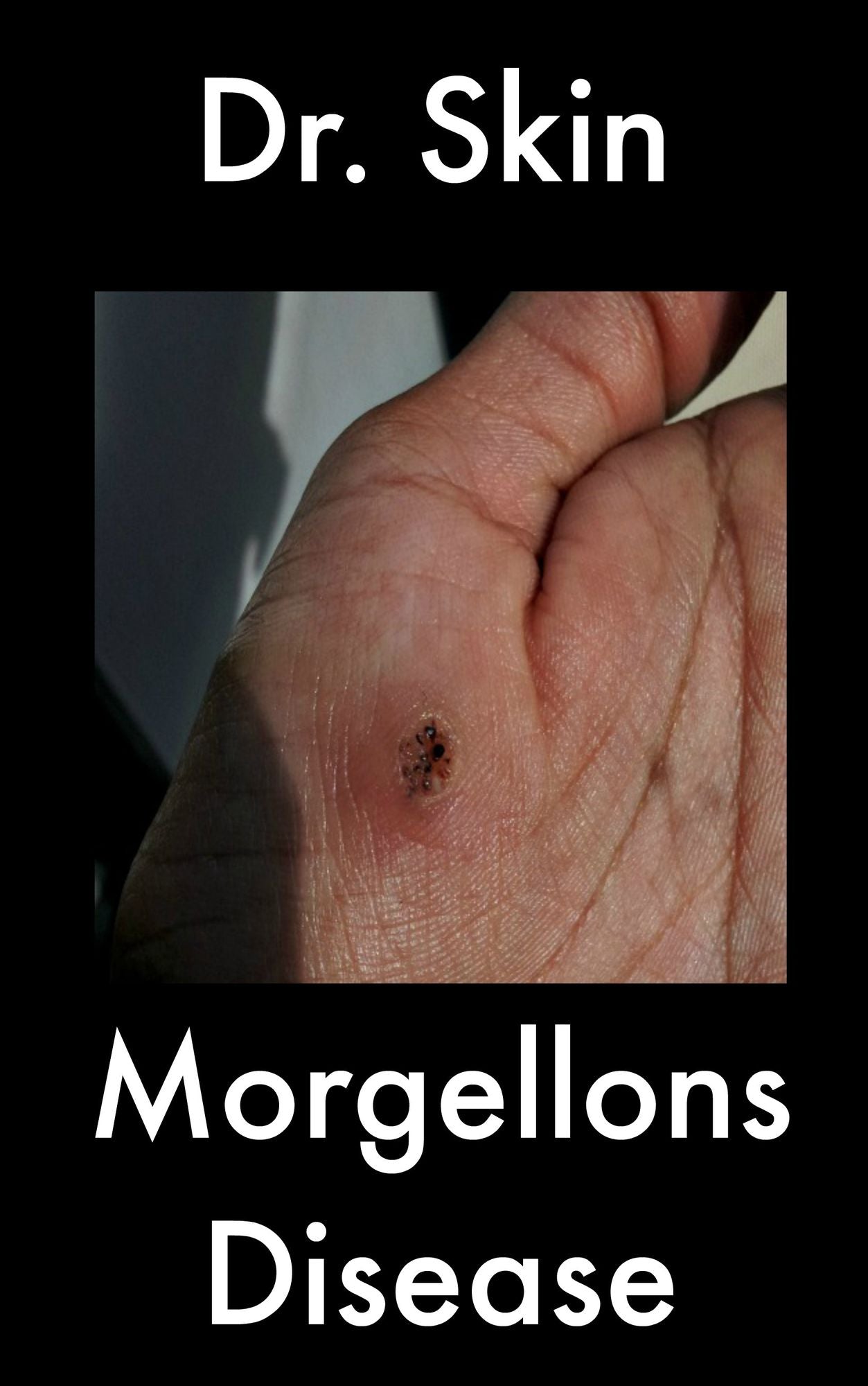 Morgellons Disease