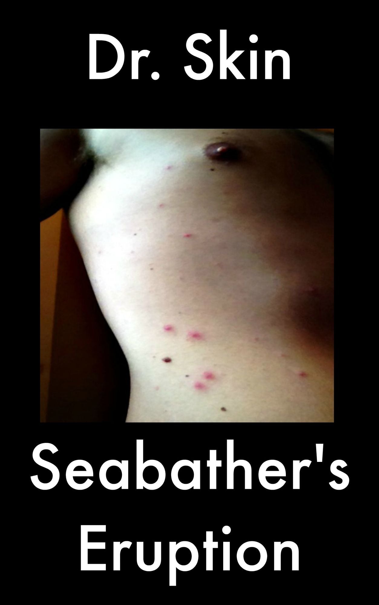 Seabather's Eruption