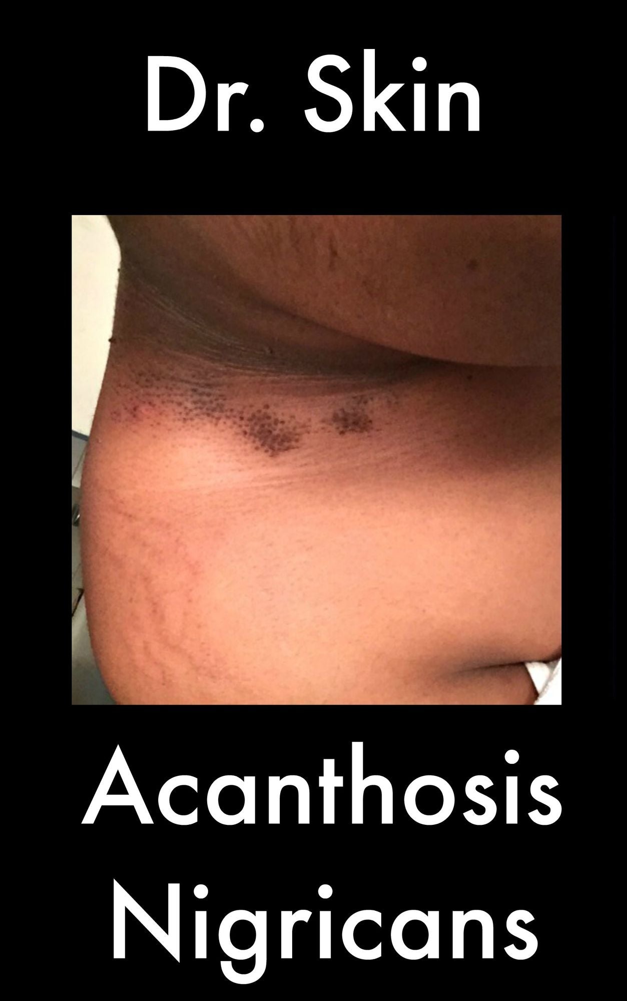 Acanthosis Nigricans