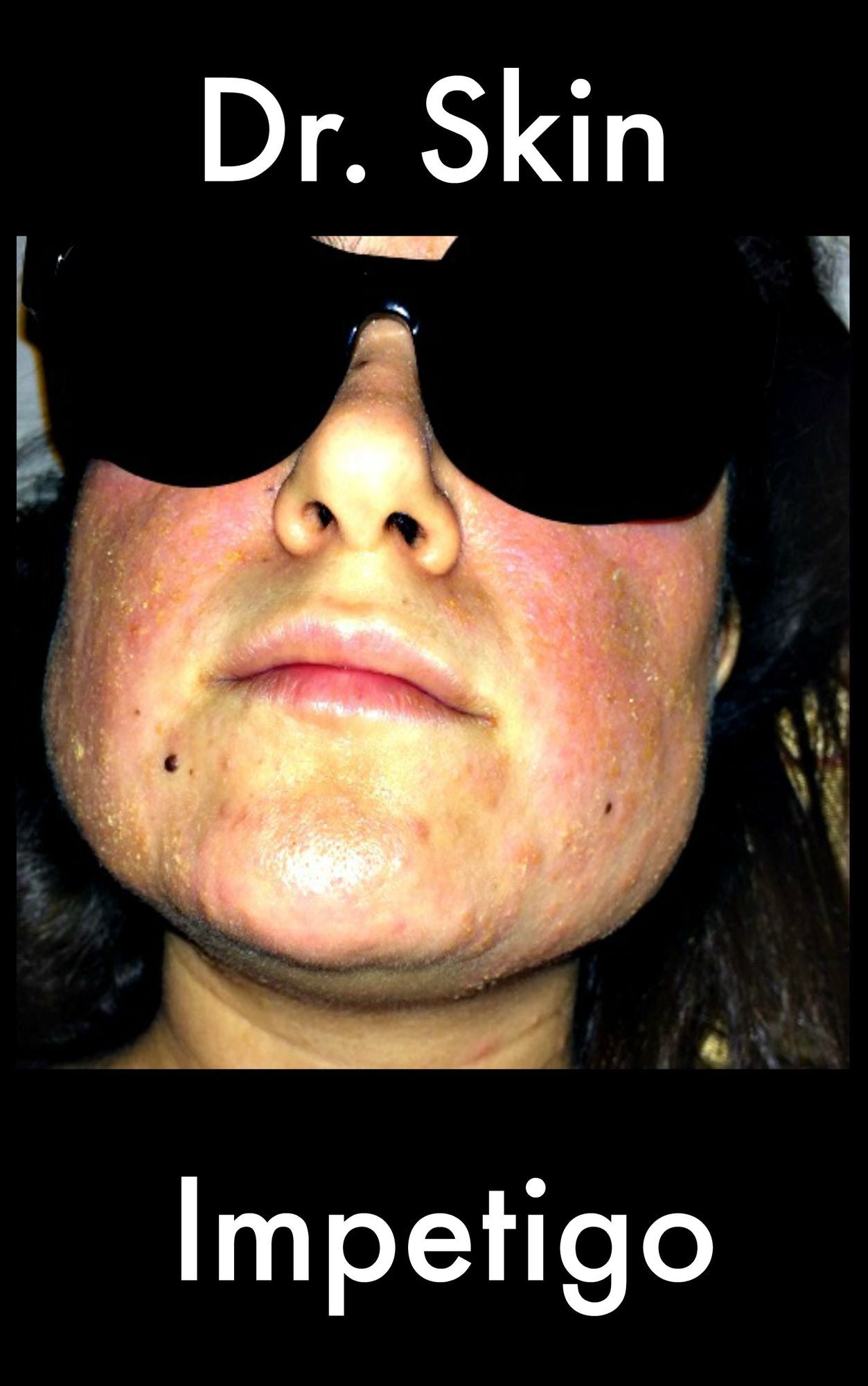 Impetigo