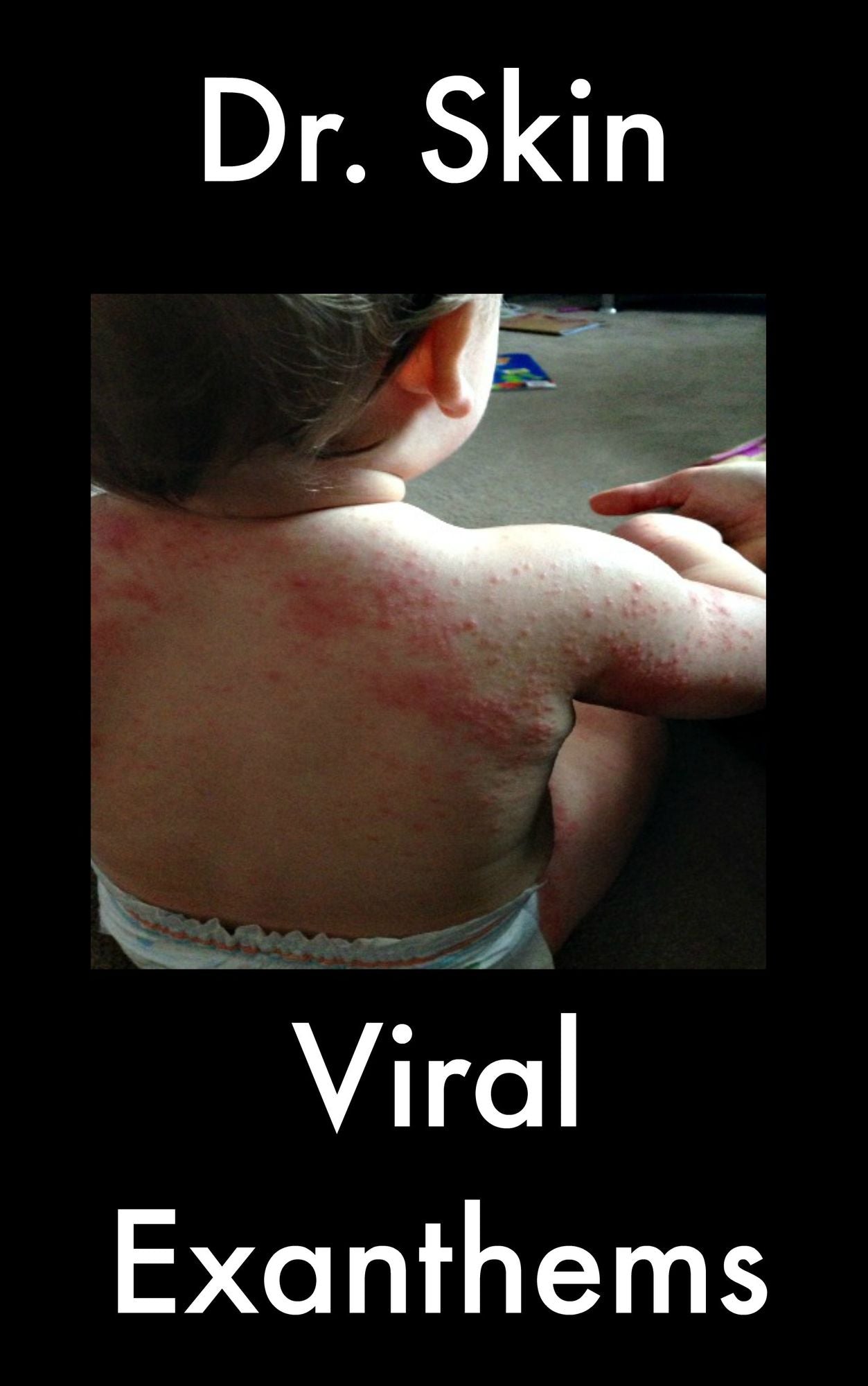 Viral Exanthems