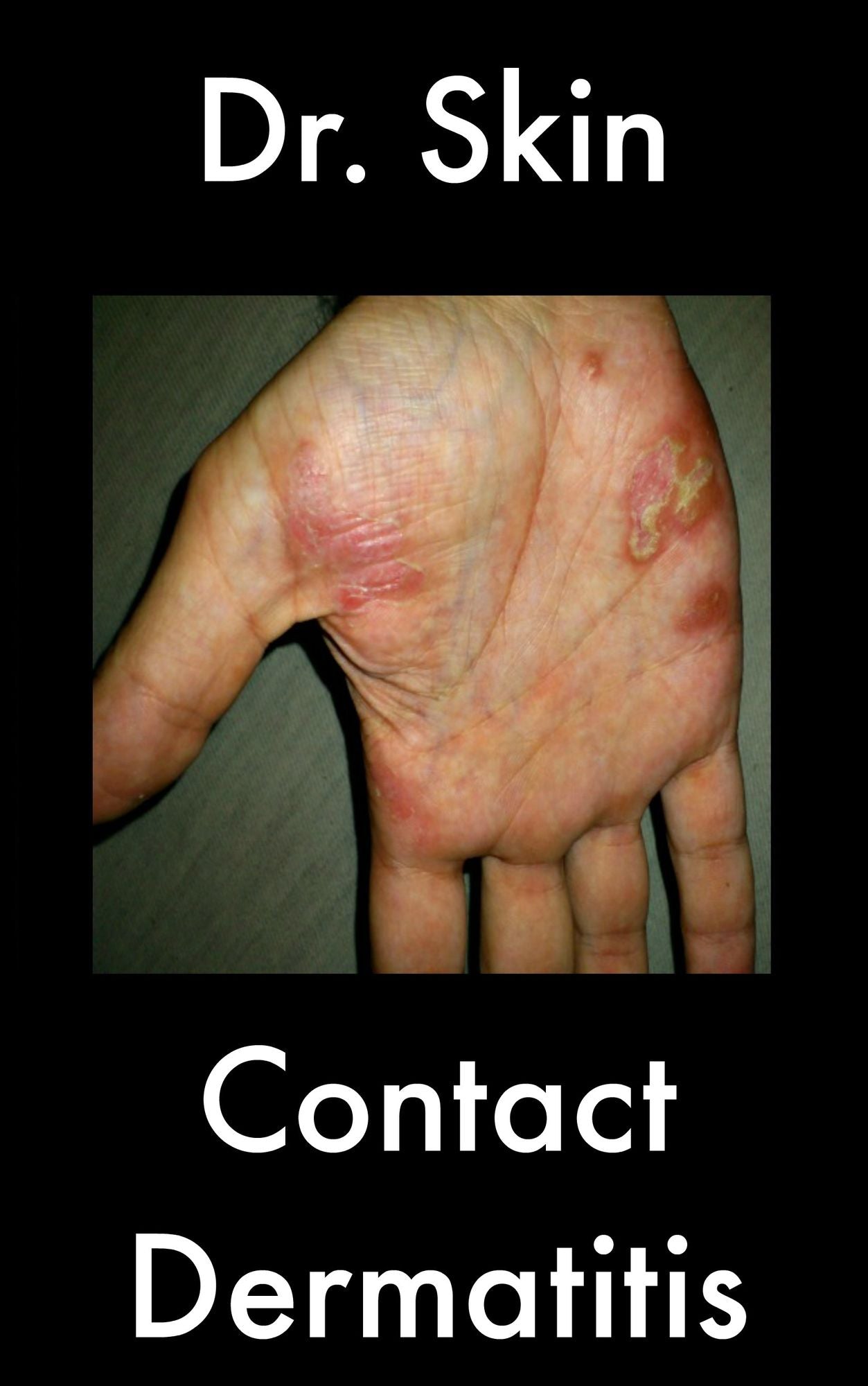 Contact Dermatitis