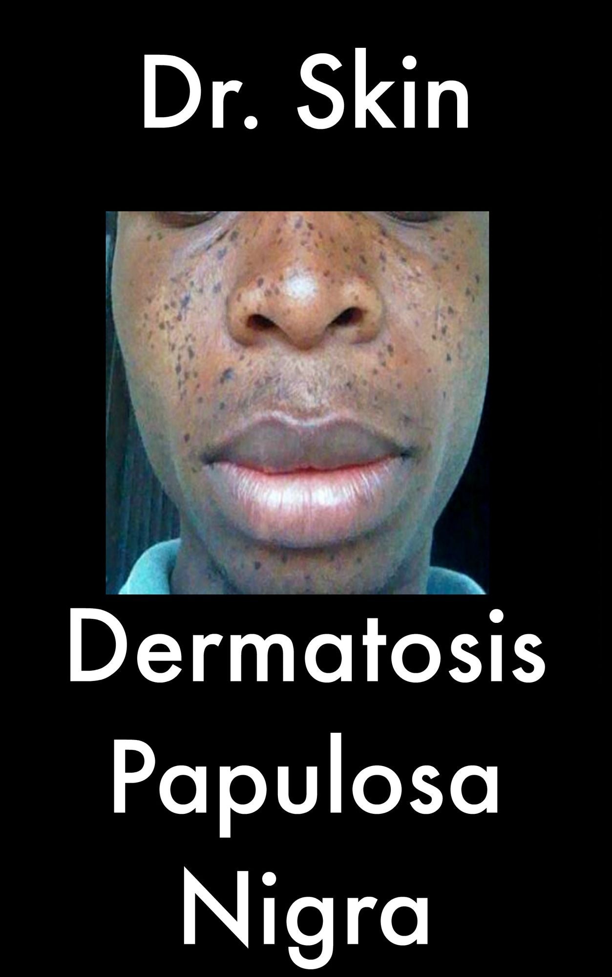 Dermatosis Papulosa Nigra