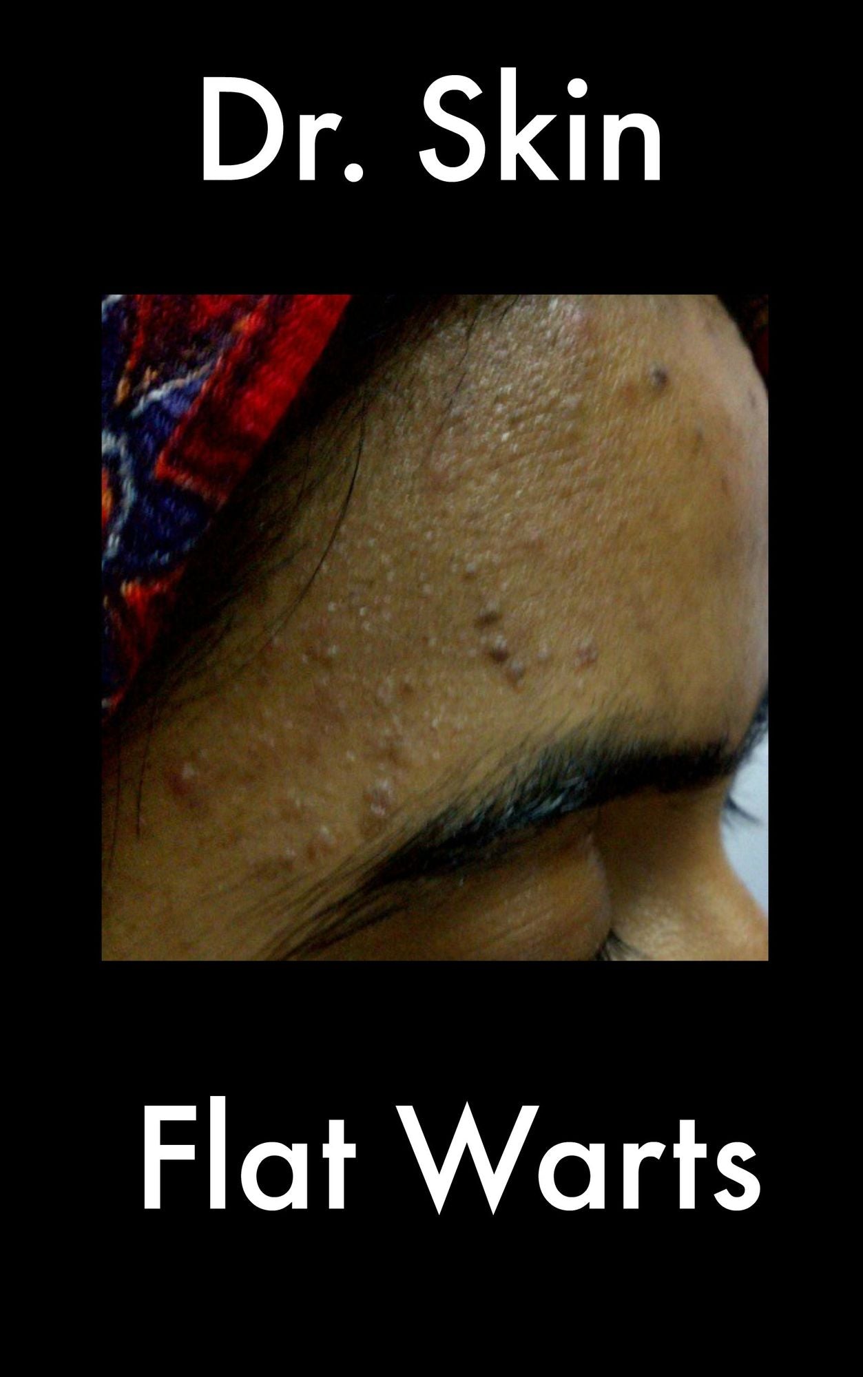 Flat Warts