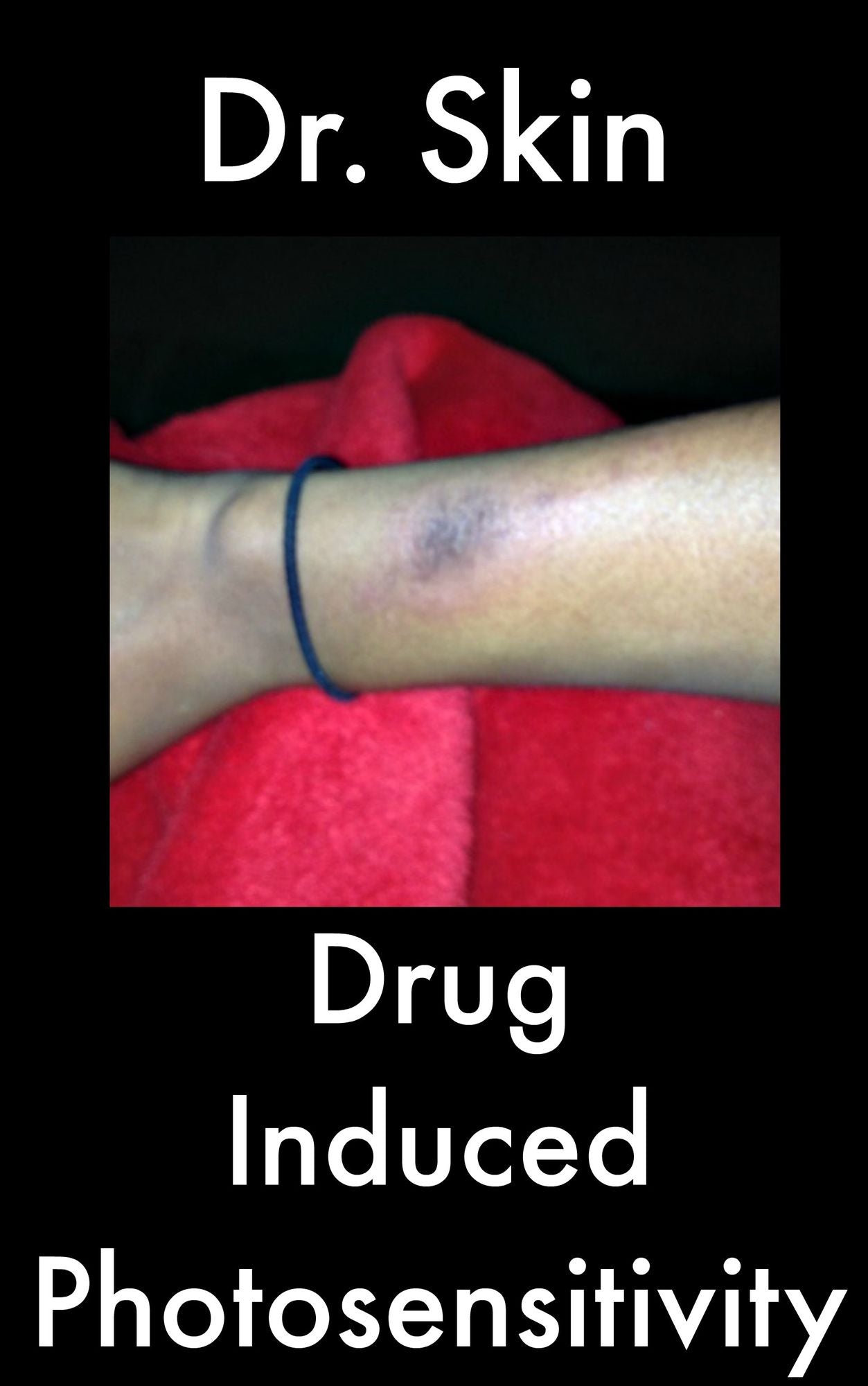 Drug Induced Photosensitivity