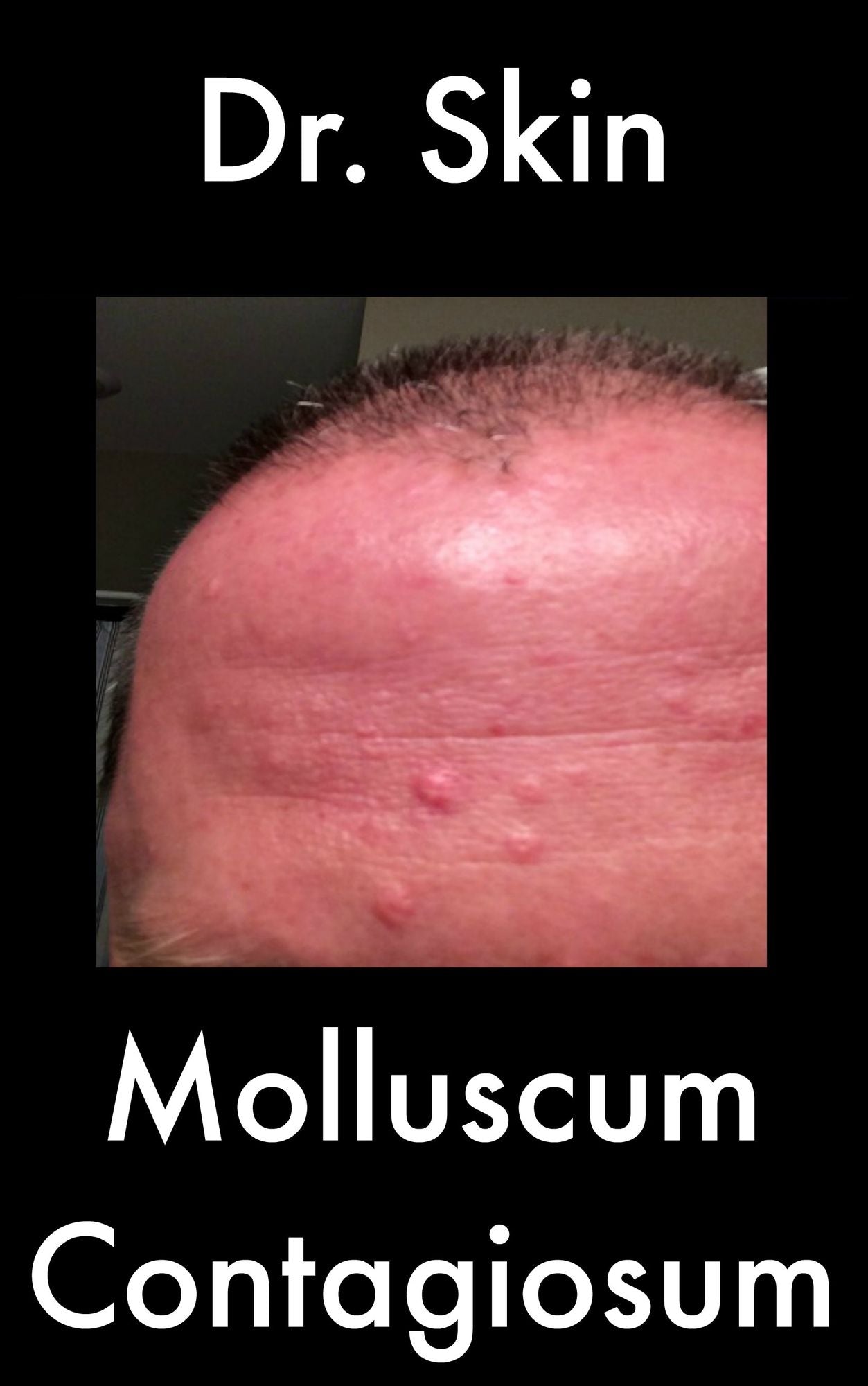 Molluscum Contagiosum