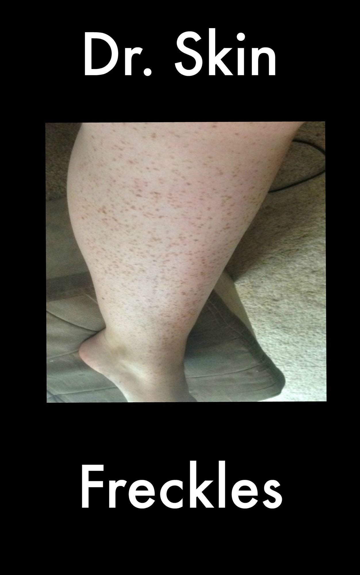 Freckles