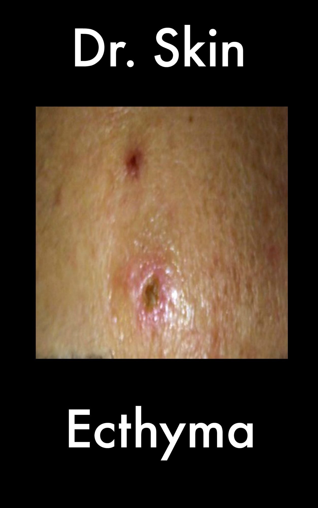 Ecthyma