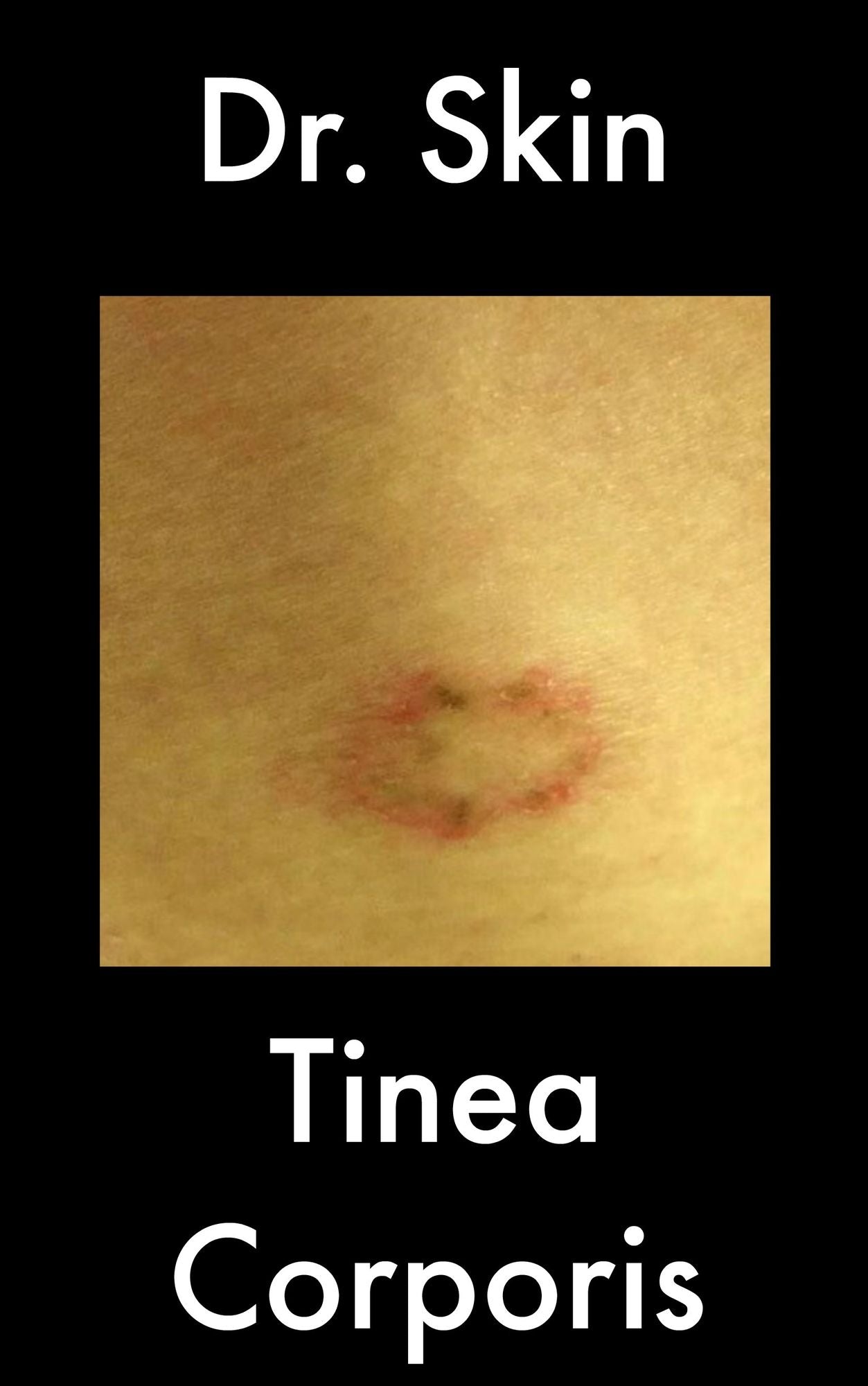 Tinea Corporis