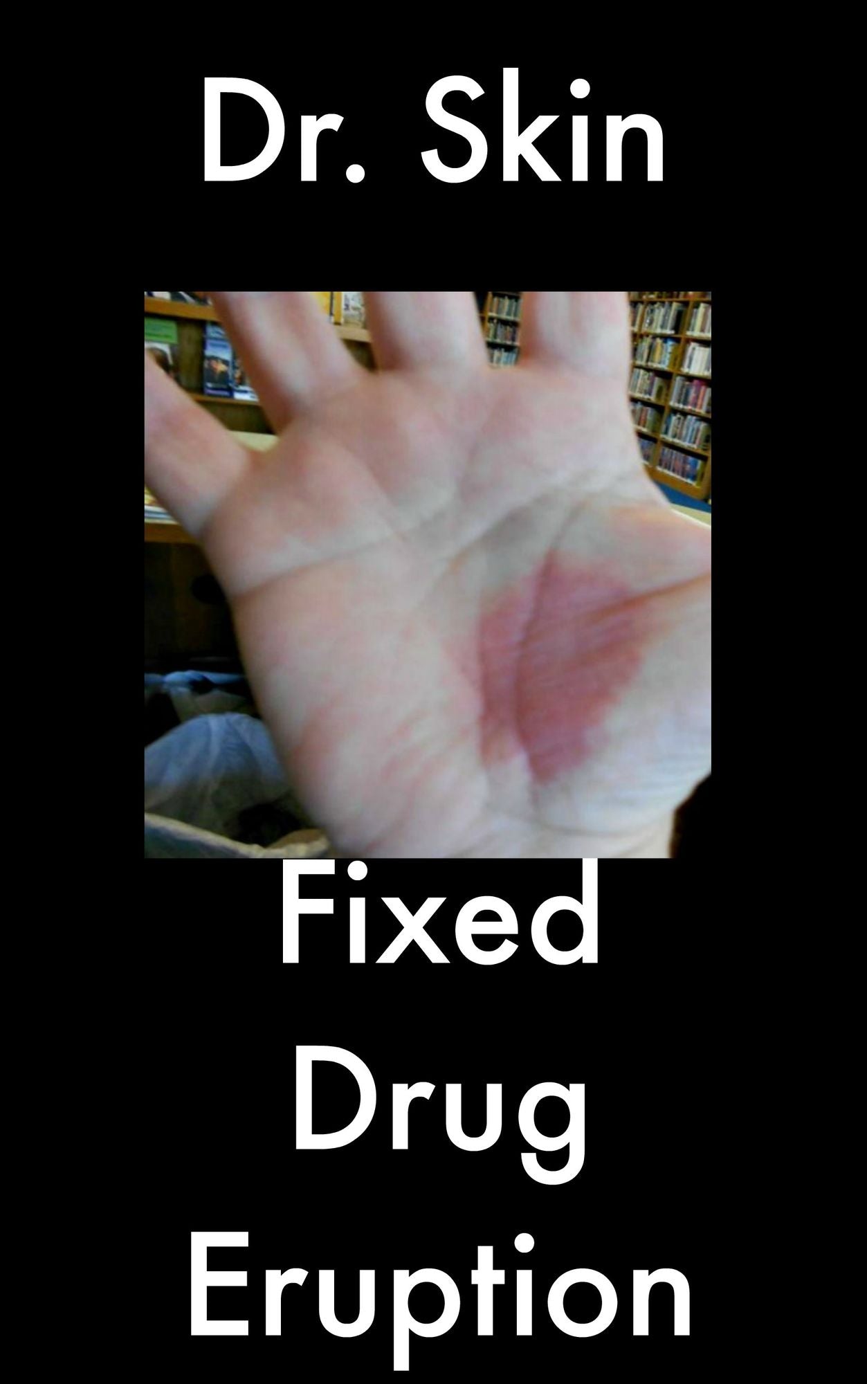 Fixed Drug Eruption