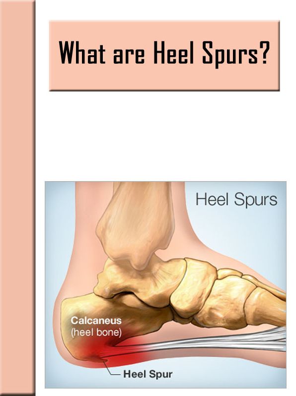 What are Heel Spurs?