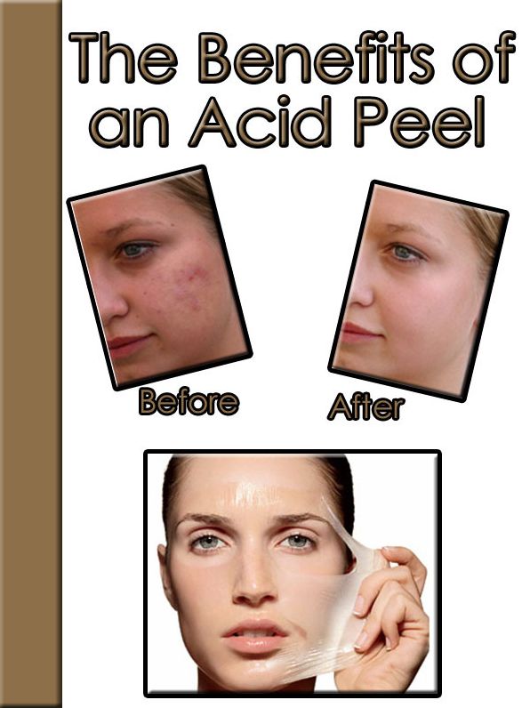 The Benefits of an Acid Peel