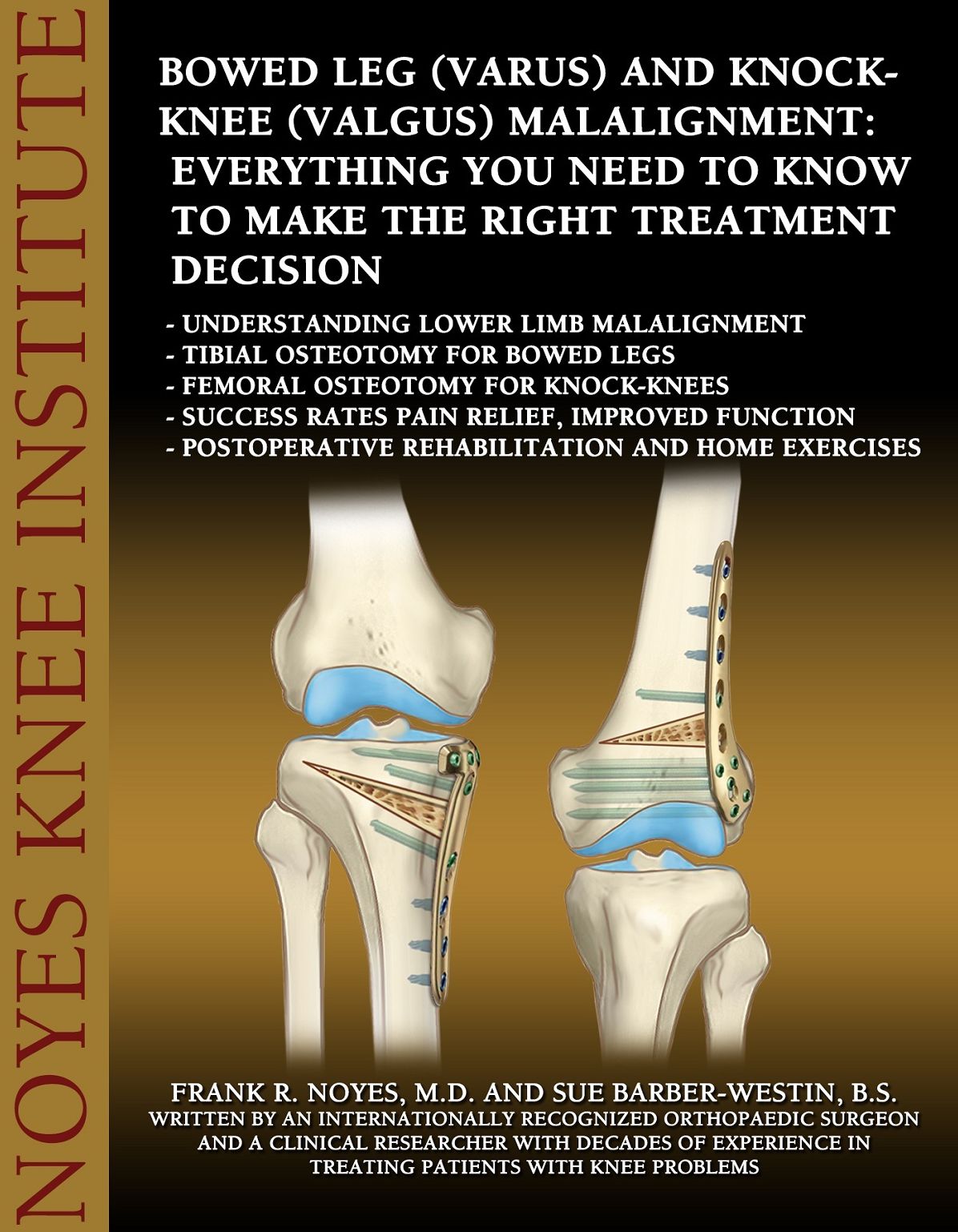 Bowed Leg (Varus) and Knock-Knee (Valgus) Malalignment: Everything You Need to Know to Make the Right Treatment Decision - Understanding lower limb malalignment - Tibial osteotomy for bowed legs - Femoral osteotomy for knock-knees - Success rates pain rel
