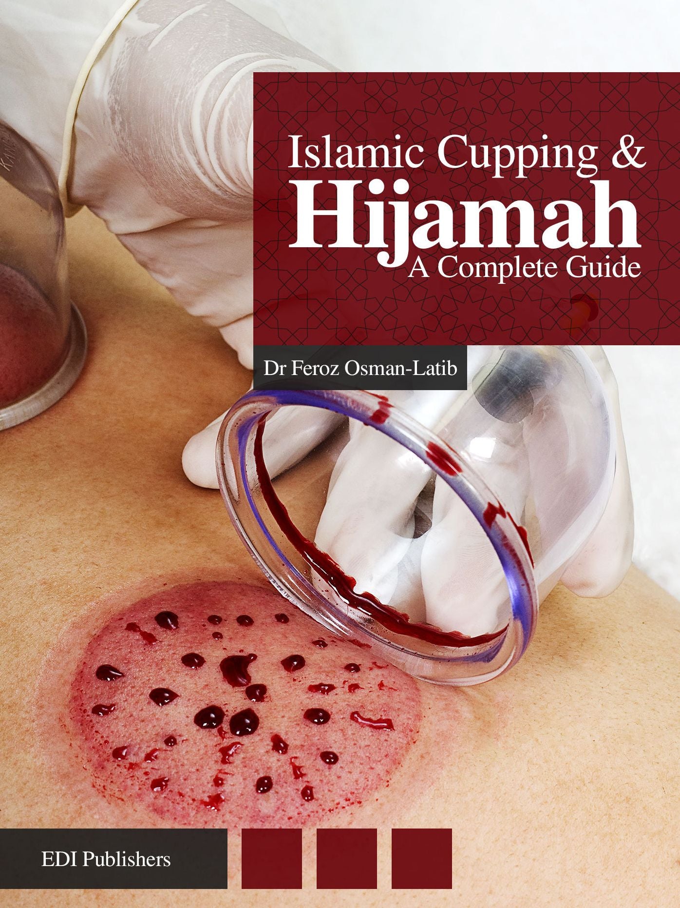 Islamic Cupping & Hijamah: A Complete Guide